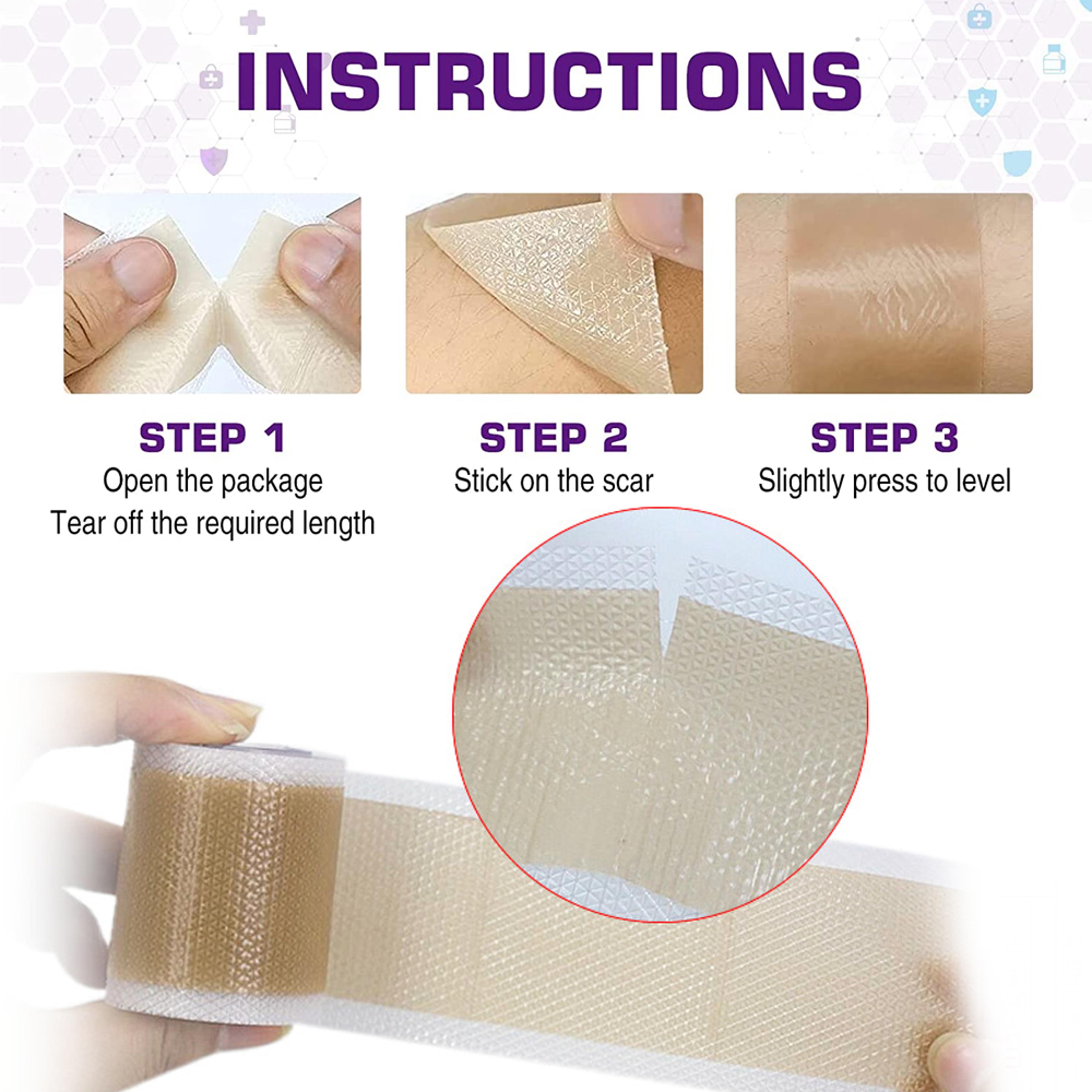 Medical Grade Silicone Scar Sheets For Keloid Surgery  Burn Healing 1