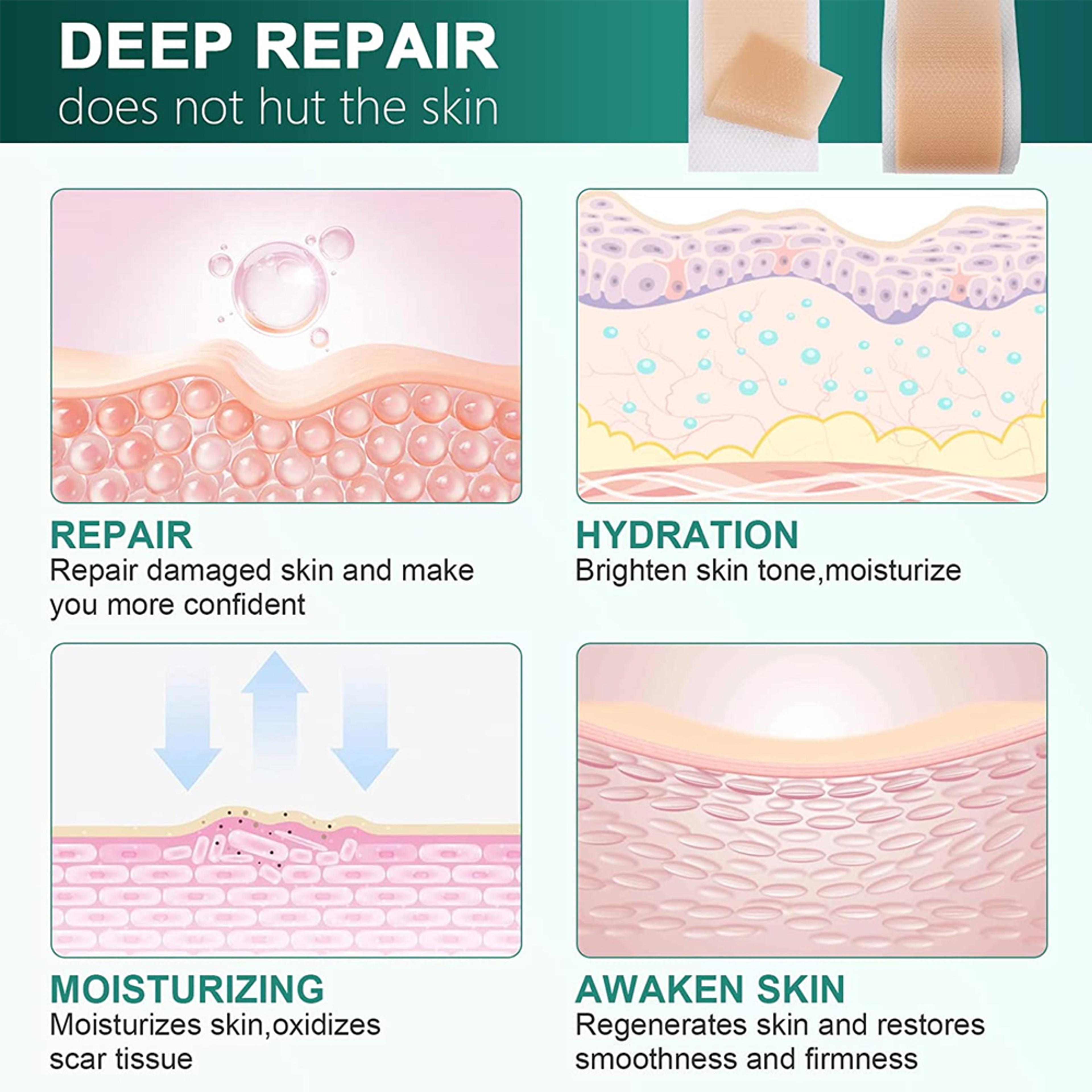 Medical Grade Silicone Scar Sheets For Keloid Surgery  Burn Healing 3