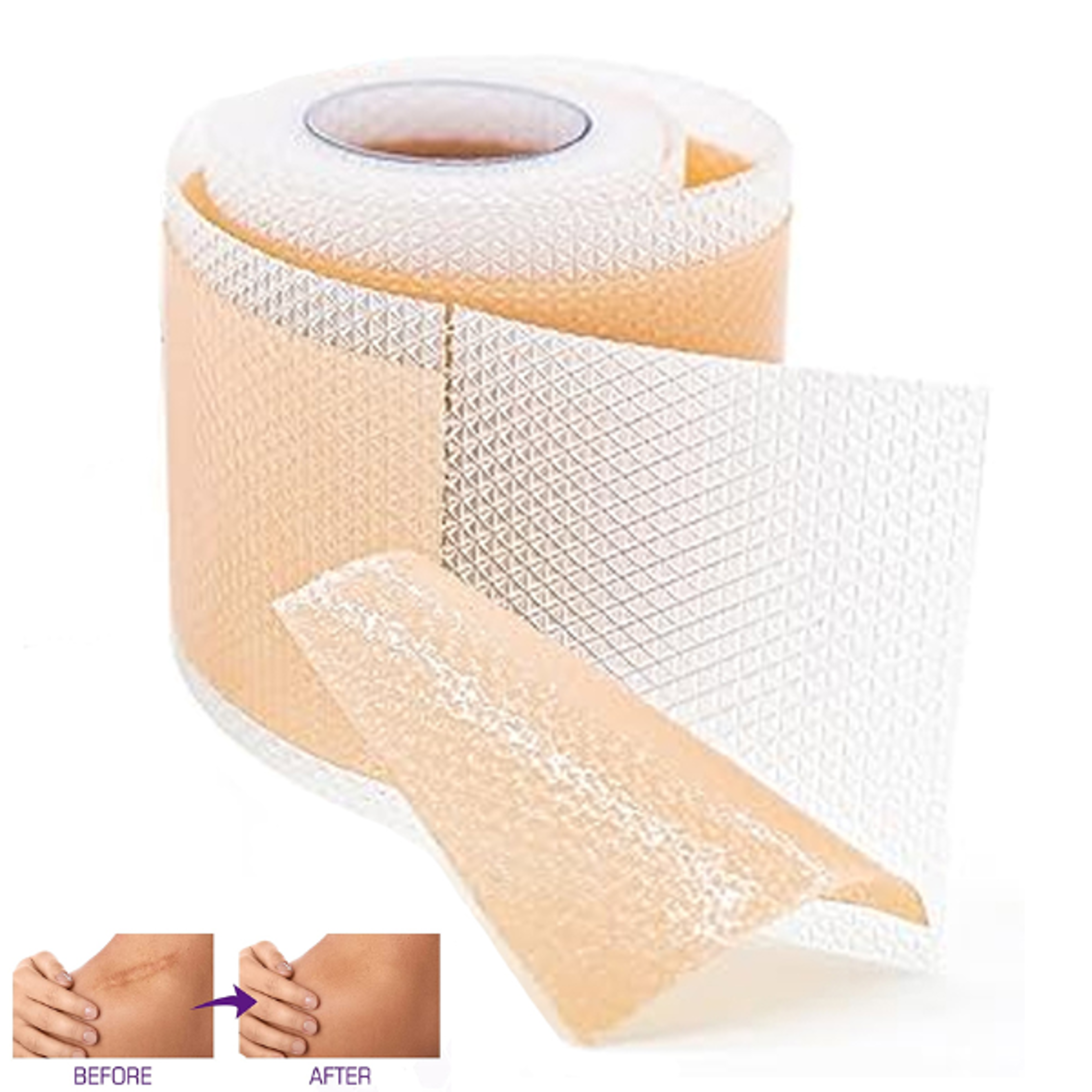 medical grade silicone scar sheets for keloid, surgery & burn healing