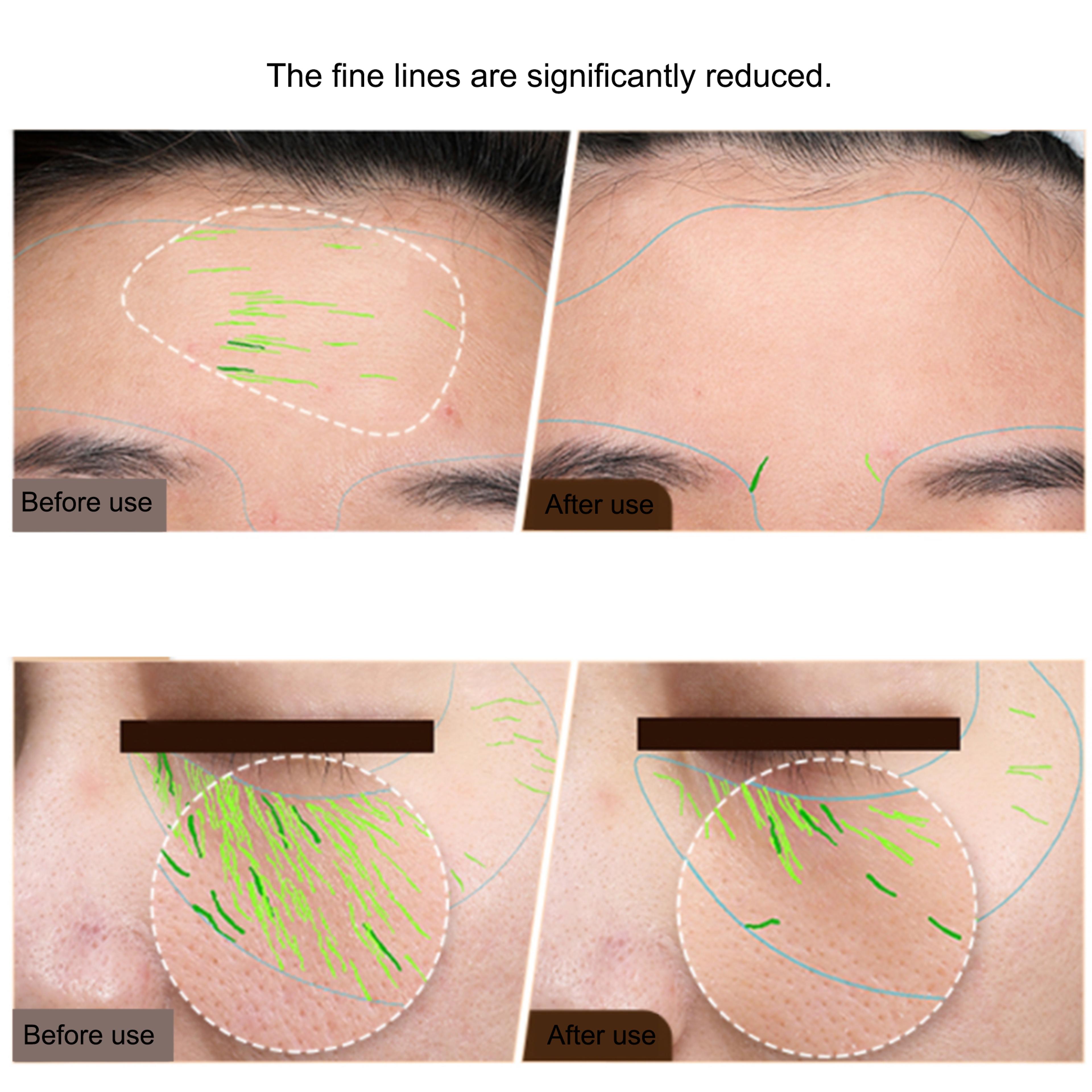 Professional EMS Facial Body Radio Frequency Machine Skin Tightening Face Lifting RF Beauty Device  2