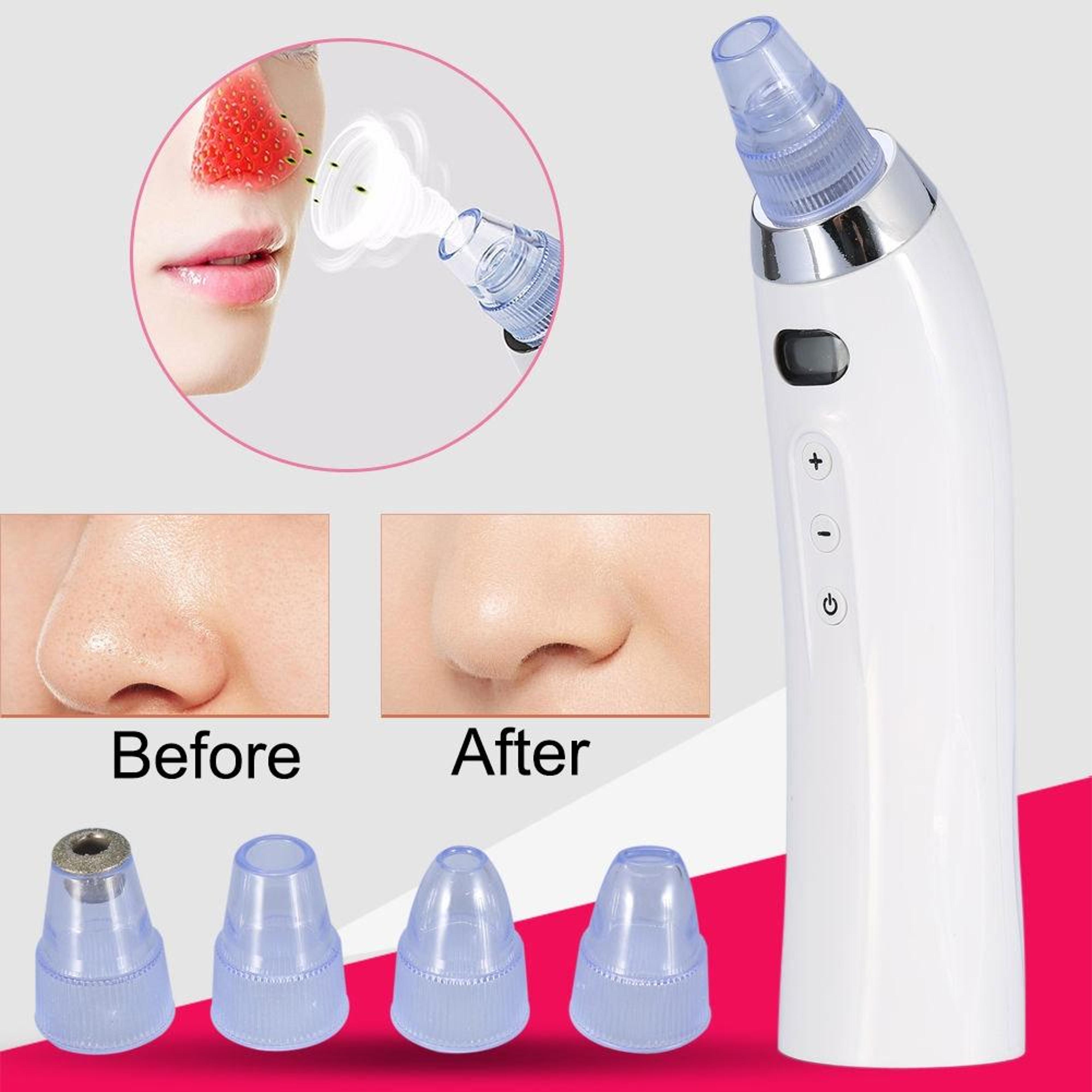 RadianceLift Blackhead Remover Vacuum  Diamond Microdermabrasion Pore Cleaner 3