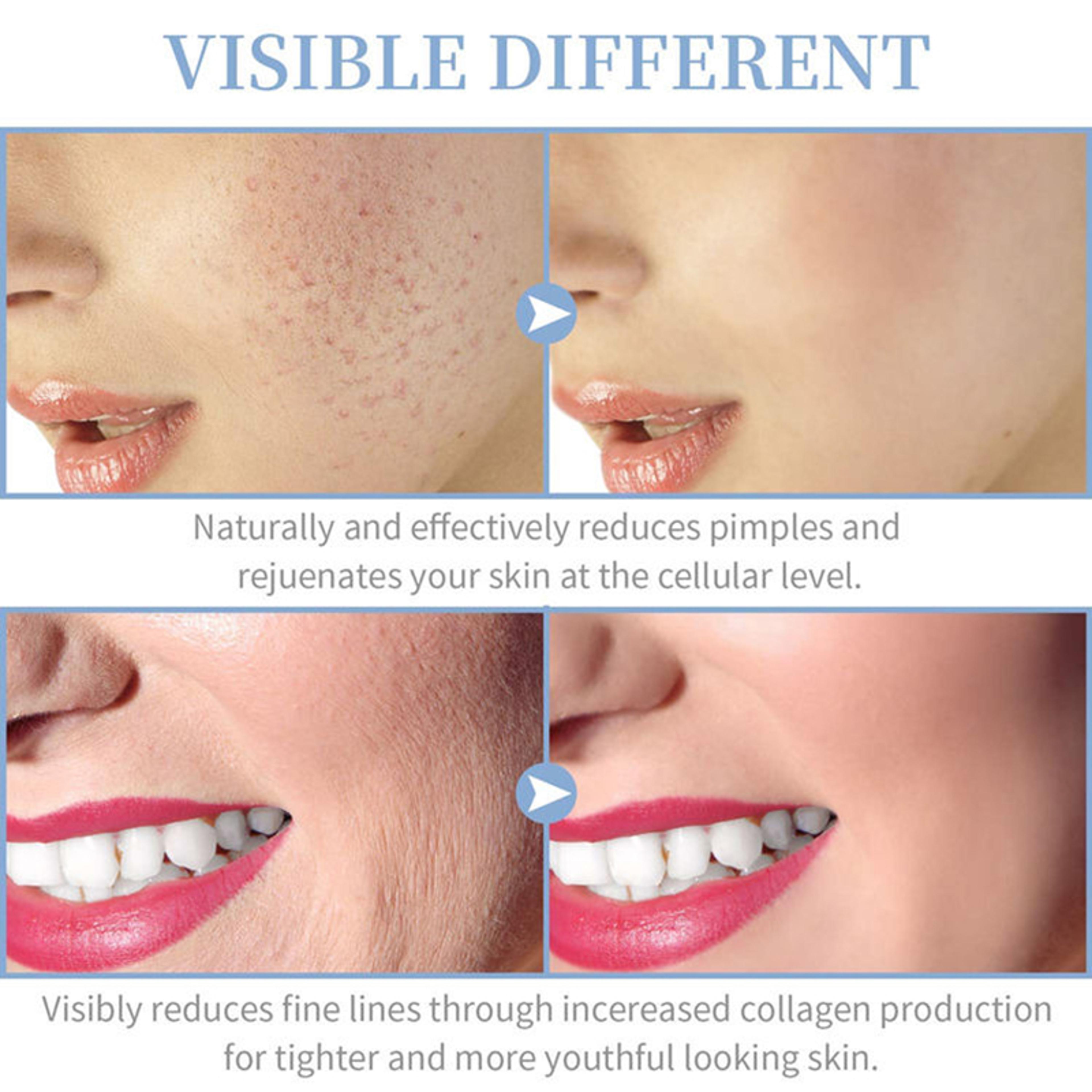 Portable High Frequency Skin Therapy Wand Handheld Facial Machine For Acne Massage Skin Rejuvenatio