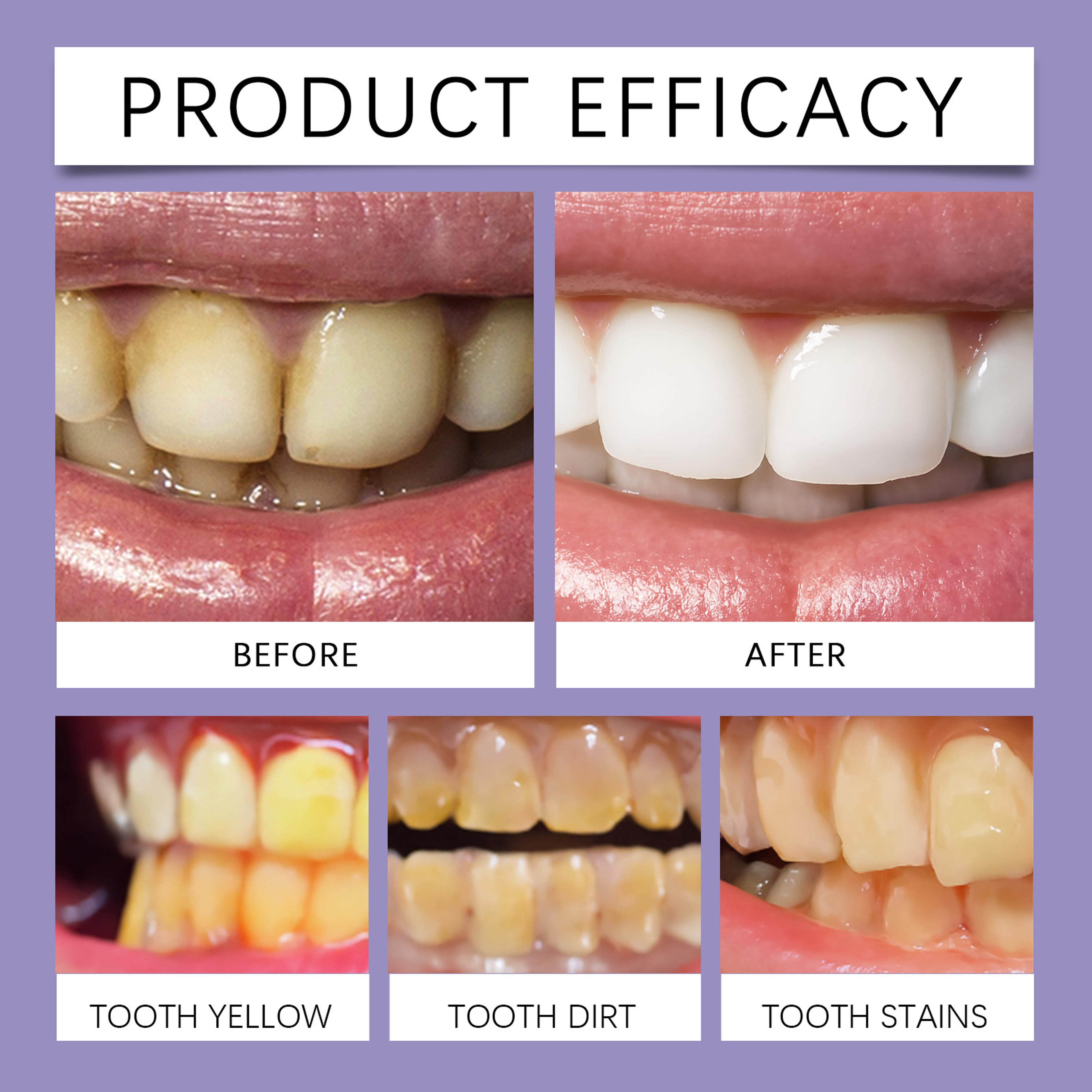Premium Purple Teeth Whitening Strips Gentle Stain Removal  Oral Care Strips For Sensitive Teeth 5
