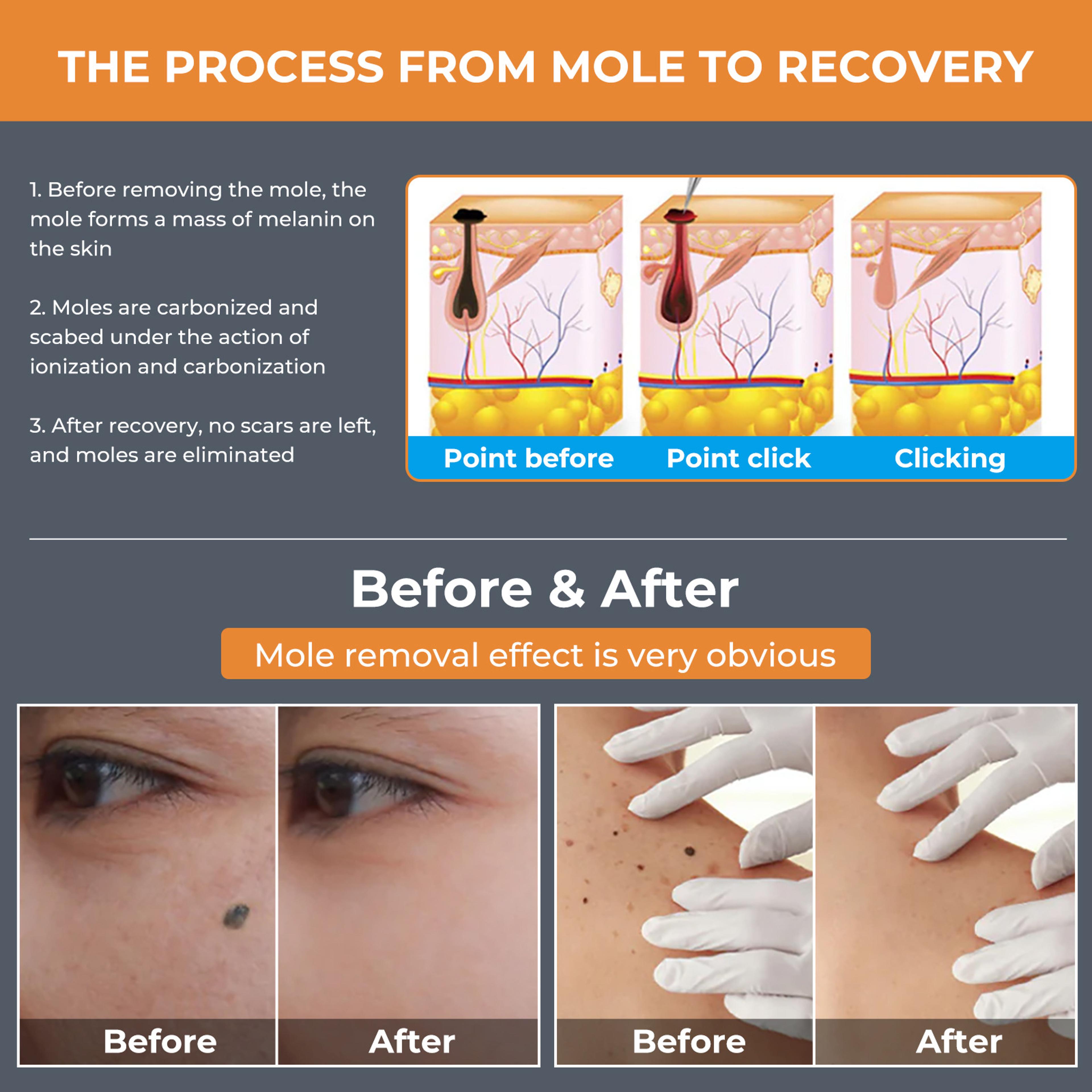 LCD Laser Plasma Pen Skin Tag Remover Kit Advanced At Home Wart Skin Tag  Mole Removal 3