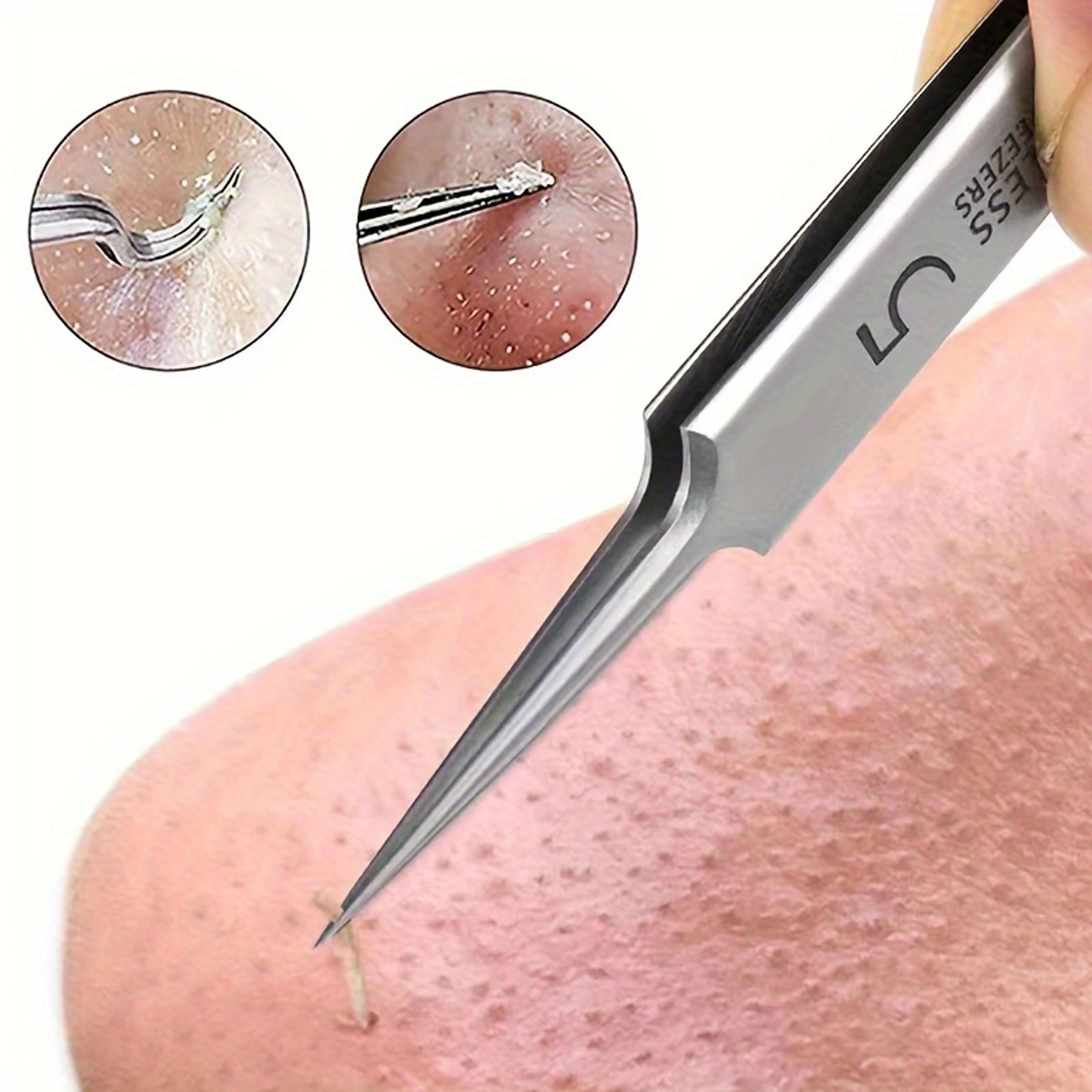 acne precision extractor tweezers for blackhead & blemish removal