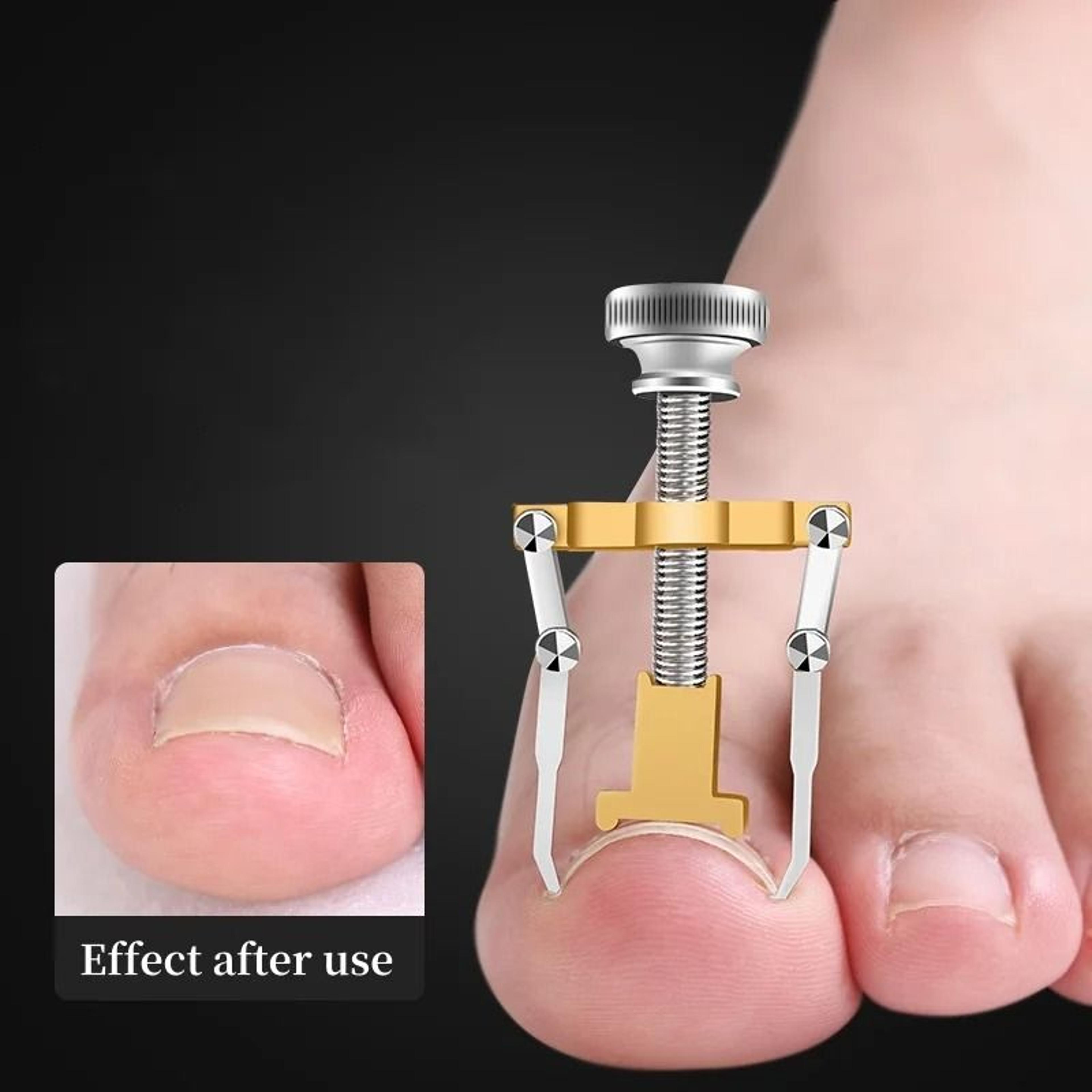 Stainless Steel Ingrown Toenail Corrector  Professional Paronychia Relief Tool 1