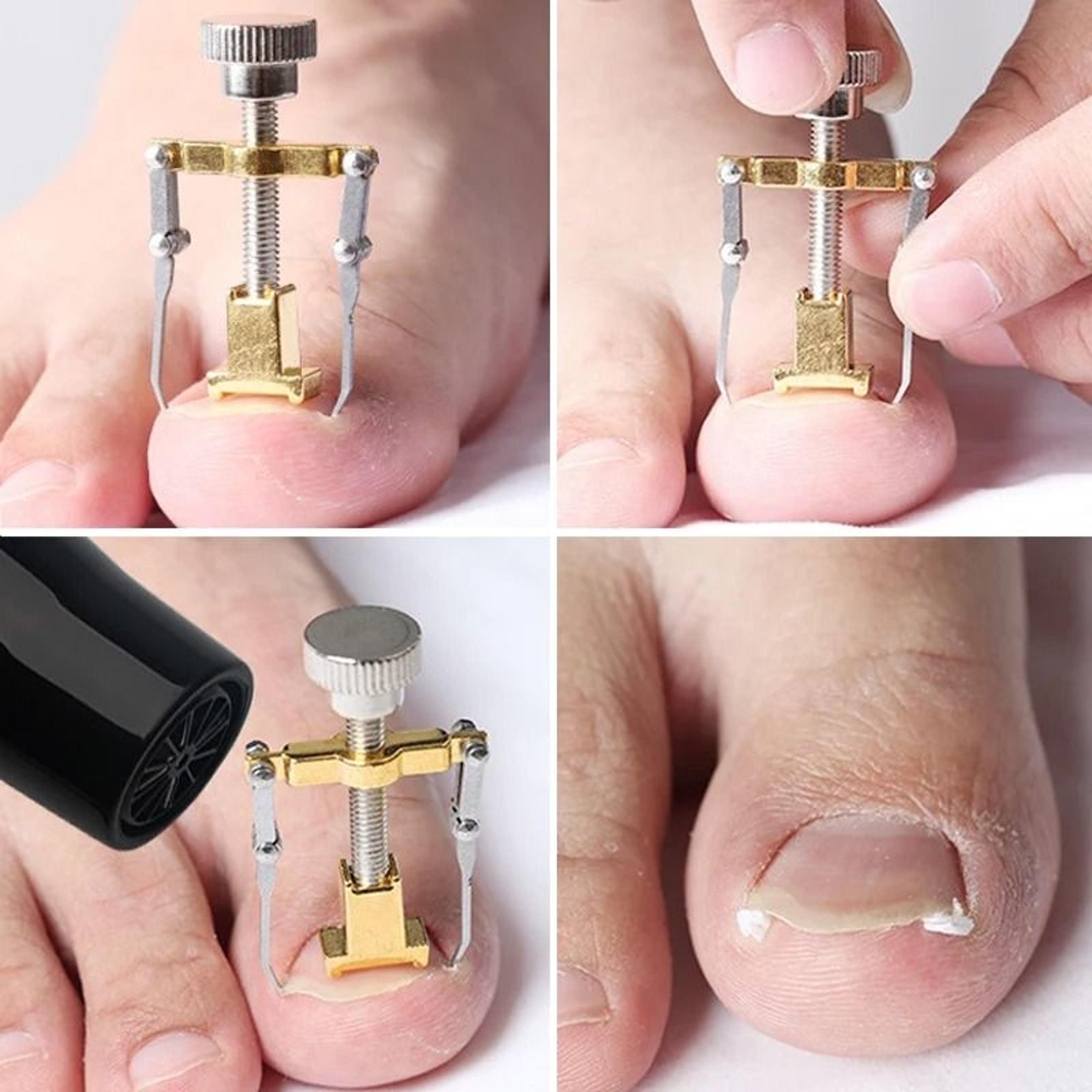Stainless Steel Ingrown Toenail Corrector  Professional Paronychia Relief Tool 2