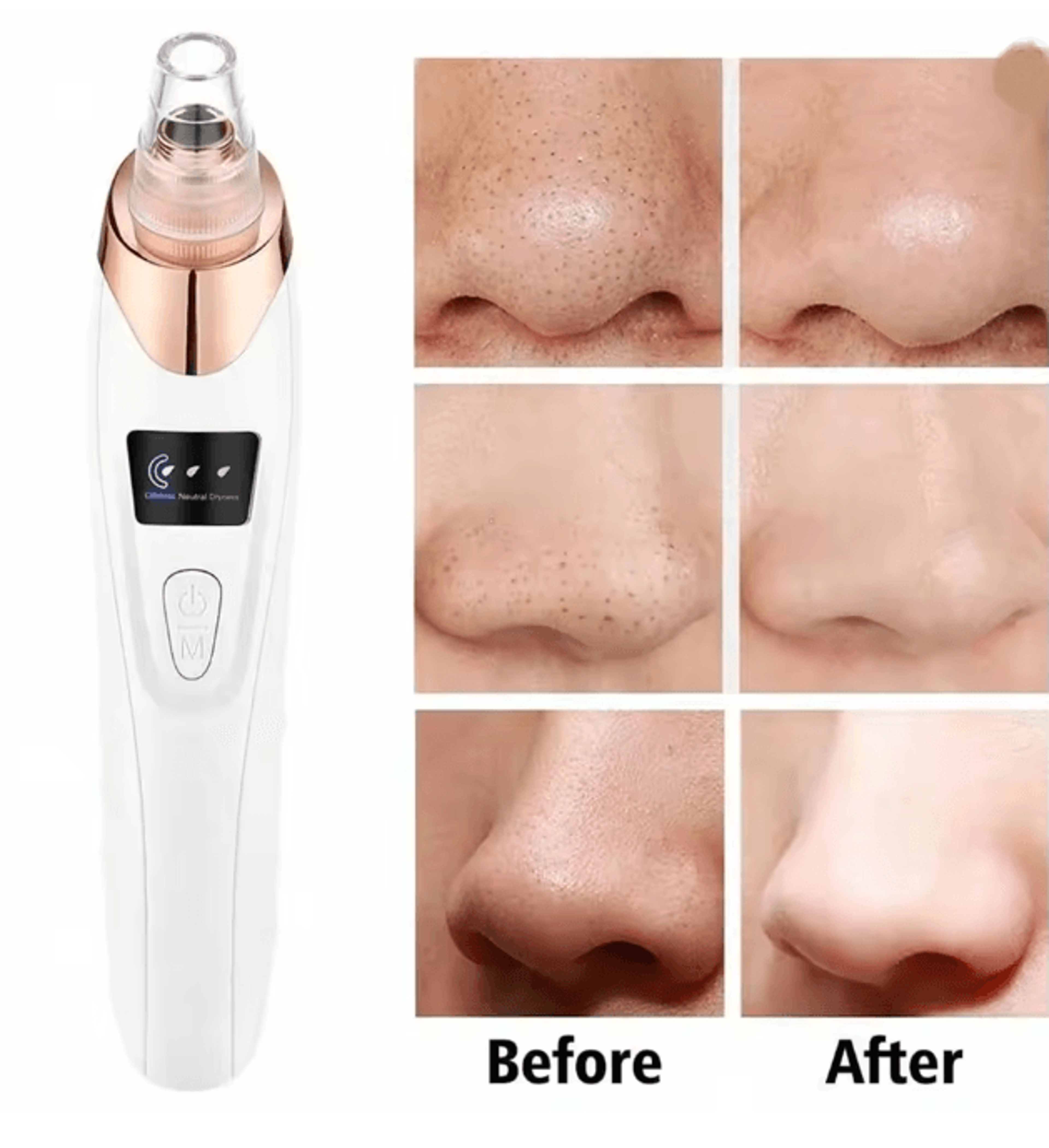 clearglow facial pore cleaner blackhead remover vacuum kit