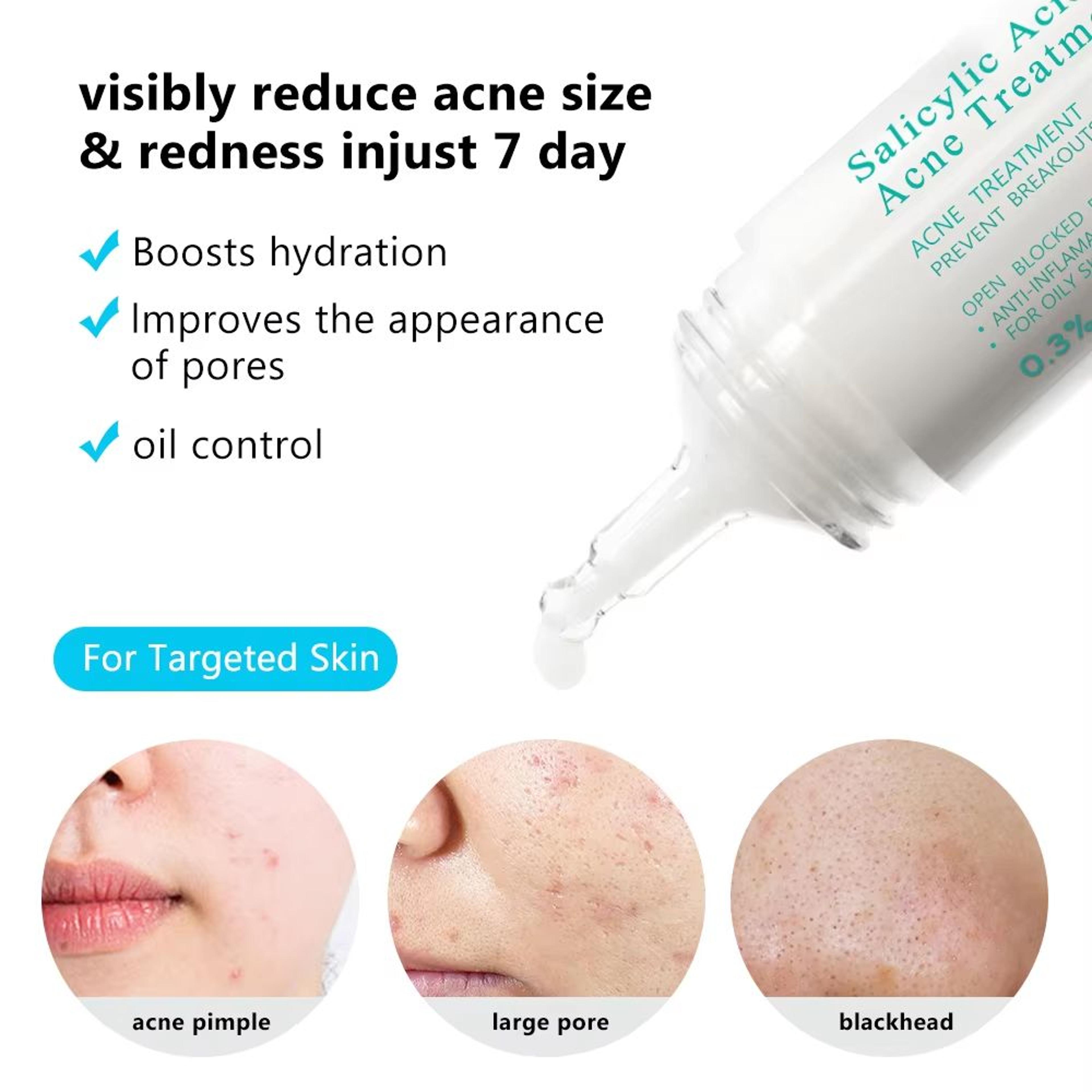 AUQUEST Salicylic Acid Acne Face Cream  Pore Refining  Blackhead Removal Niacinamide Moisturizer 2