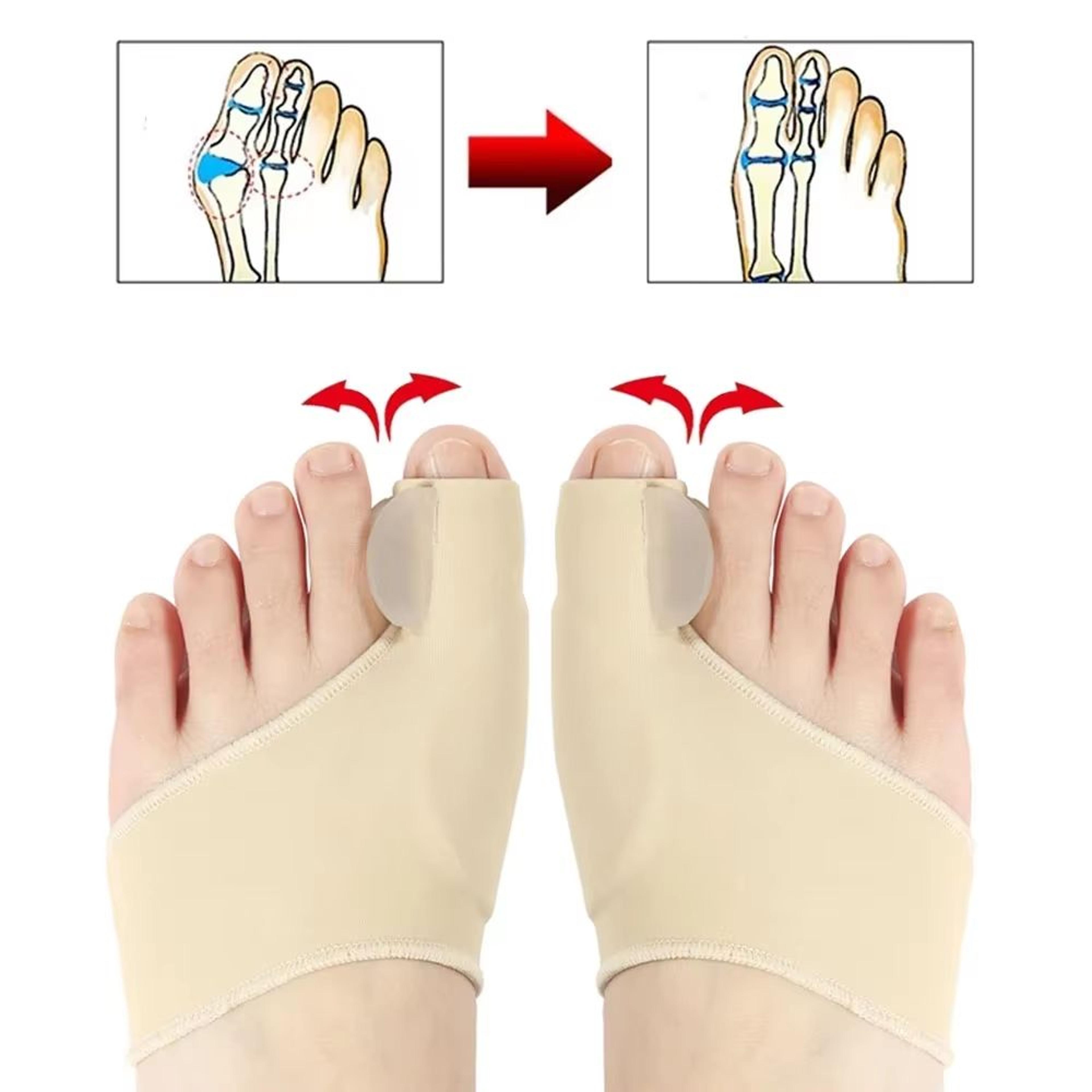 2Pack Bunion Corrector Toe Separators  Hallux Valgus Straightener  Orthopedic Foot Alignment Suppor 1