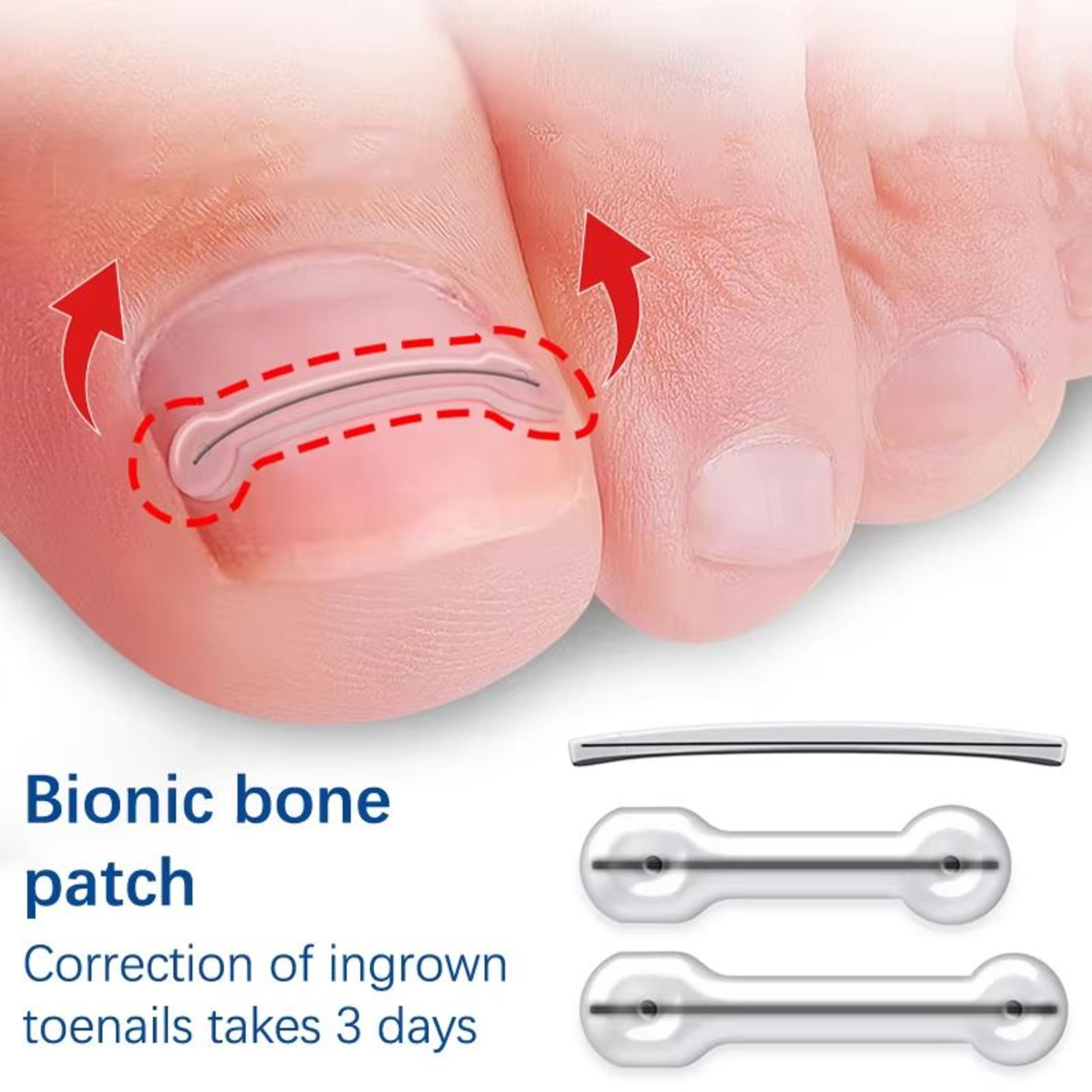 Ingrown Toenail Correction Patch Set Elastic Toe Nail Brace Pedicure Tool 0
