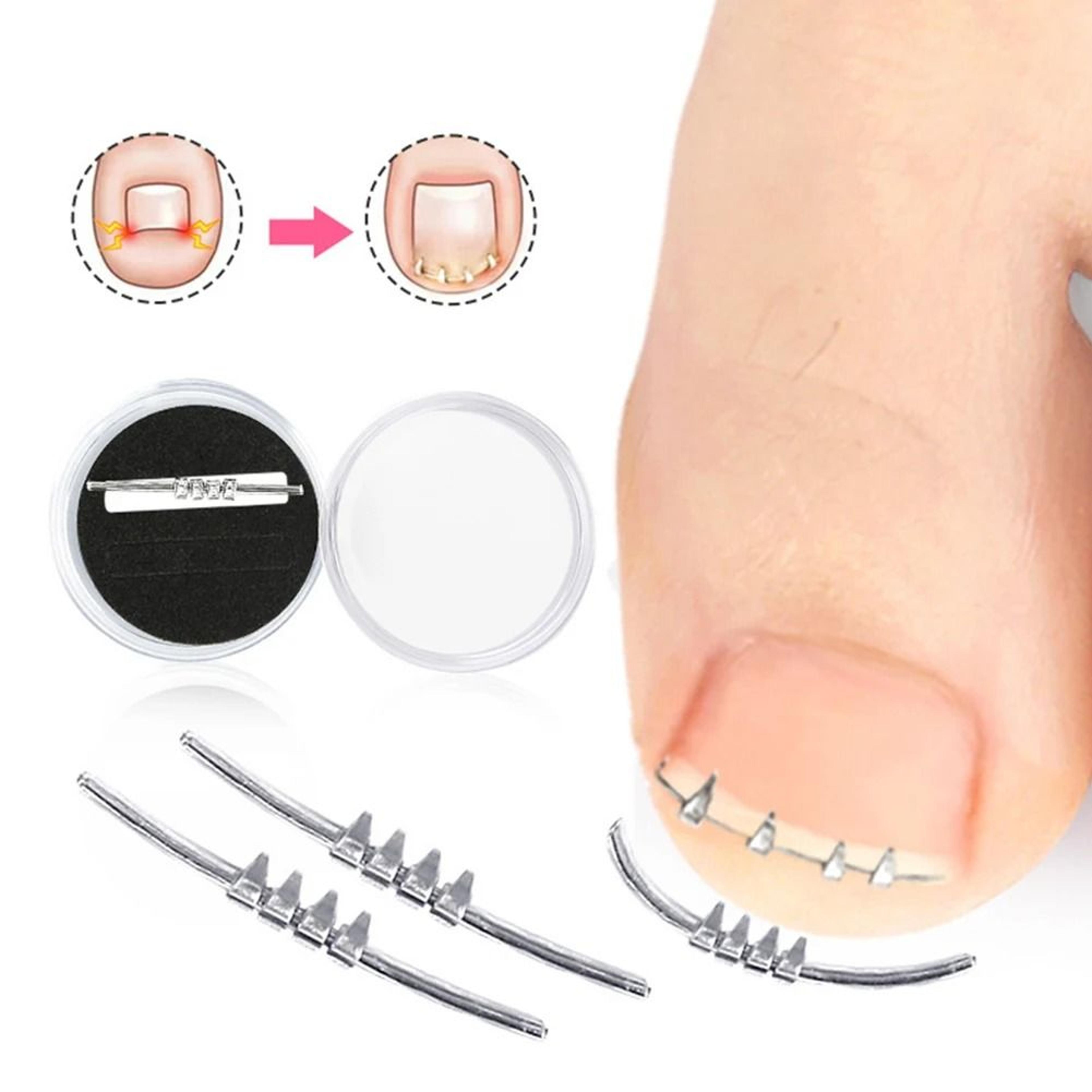precision ingrown toenail corrector | carbon steel orthopedic clamp | executive pedicure structural sanctuary