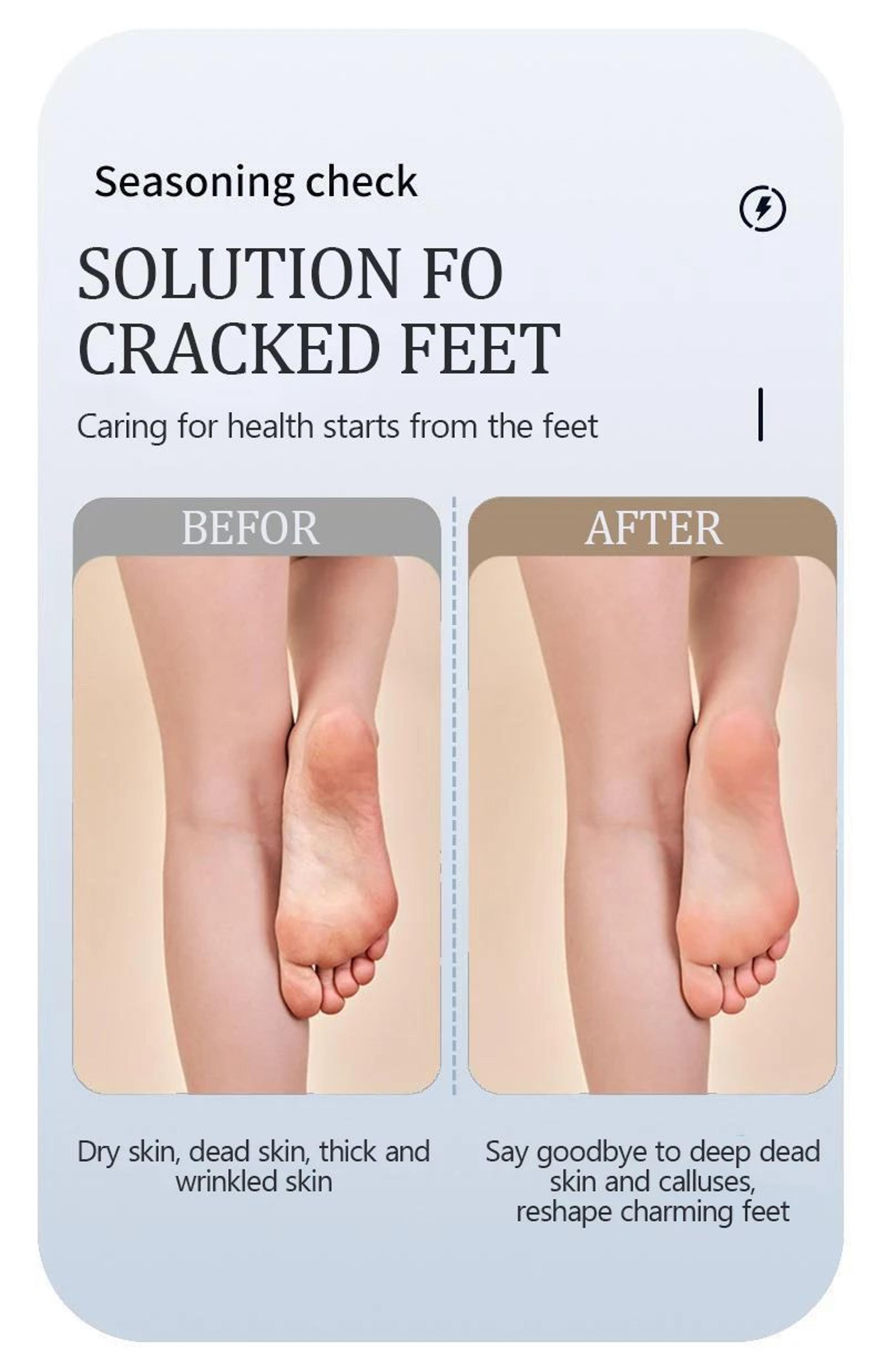 Waterproof Electric Foot Callus Remover  USB Rechargeable Heel Grinder For Dead Skin  Professional  6