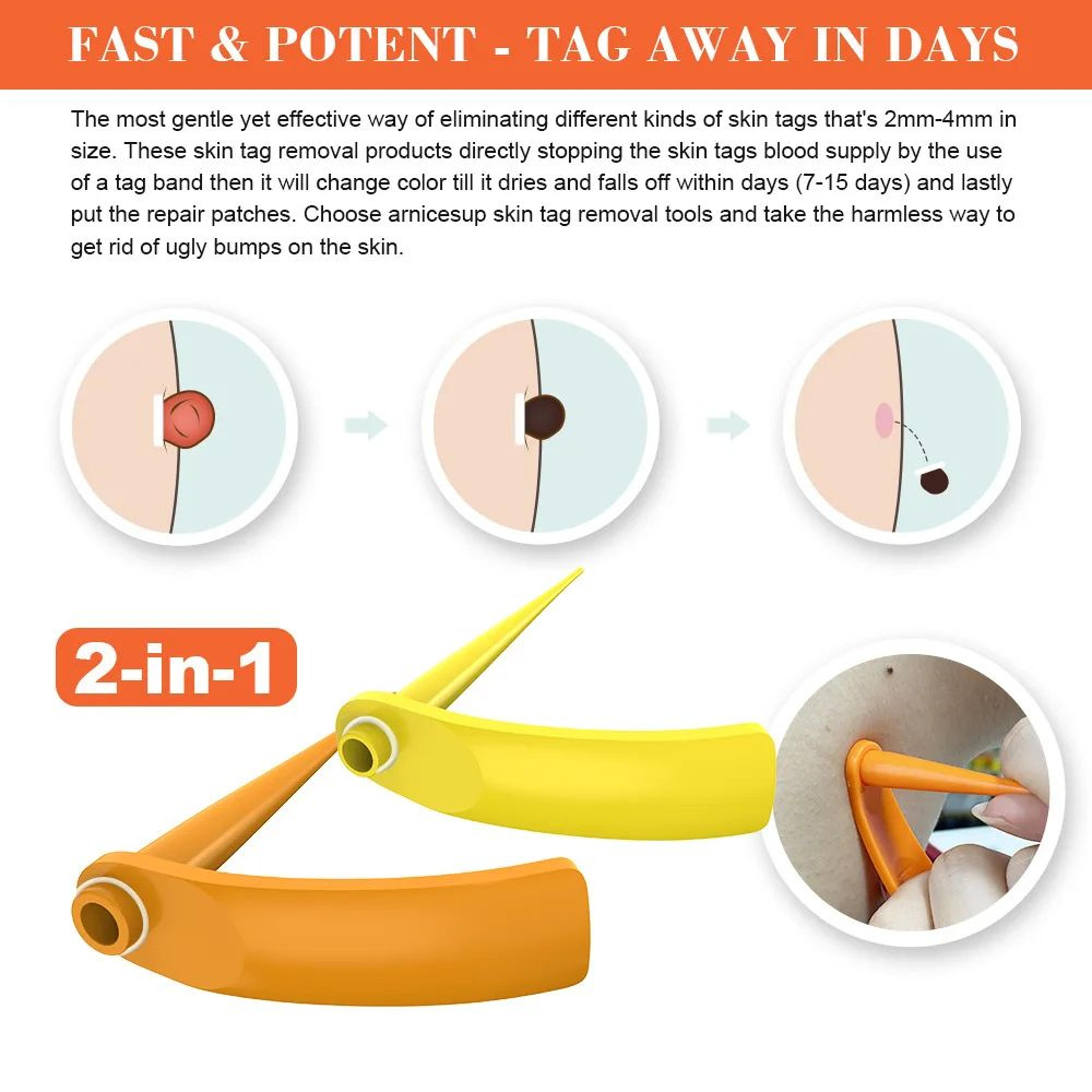 2In1 Skin Tag Removal Tool Kit  Mole Acne Wart Removal Pen  Facial Skin Care Tool 2