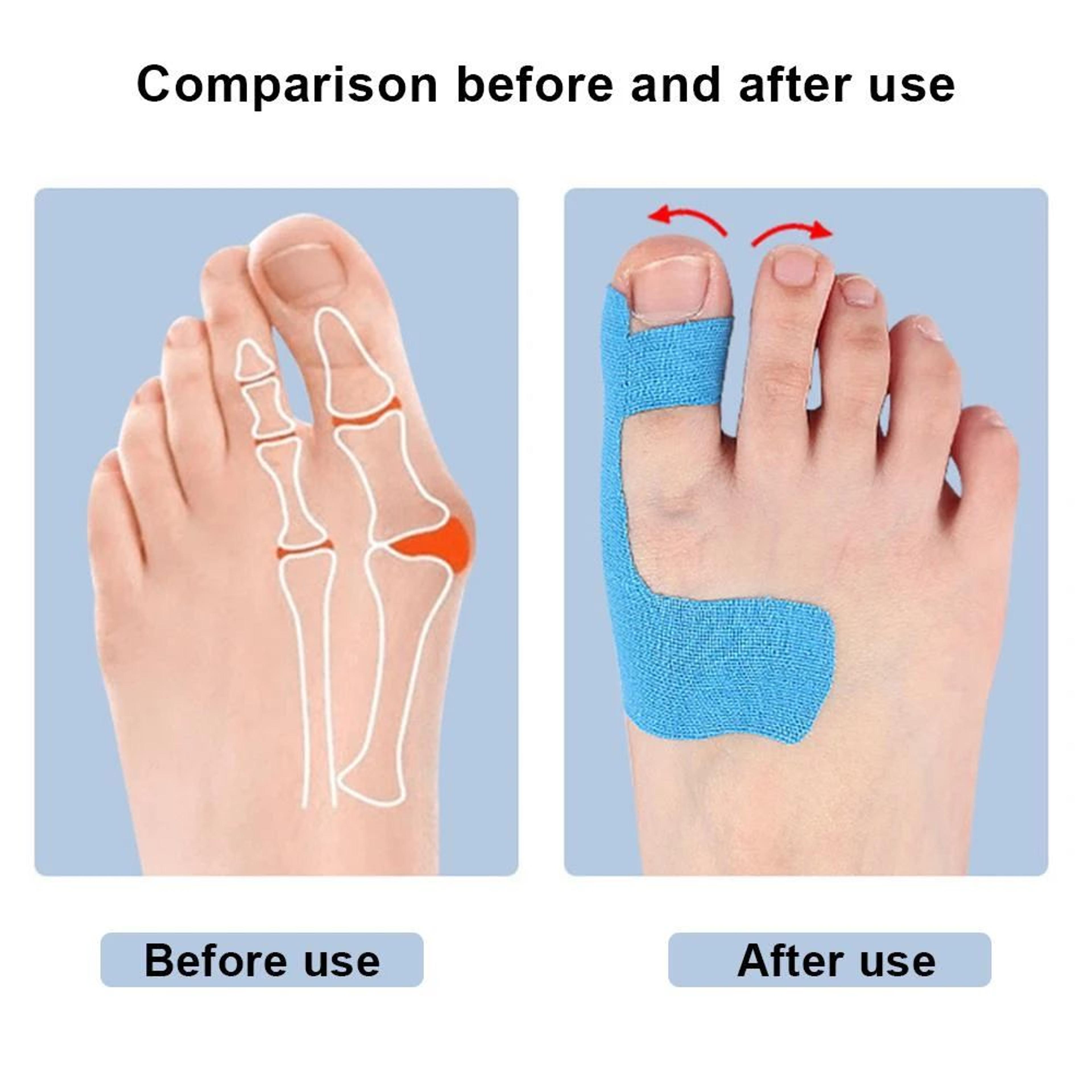 10pcs PreCut Bunion Corrector Tape  Big Toe Support Kinesiology Tape Breathable Toe Straightener Fo 2