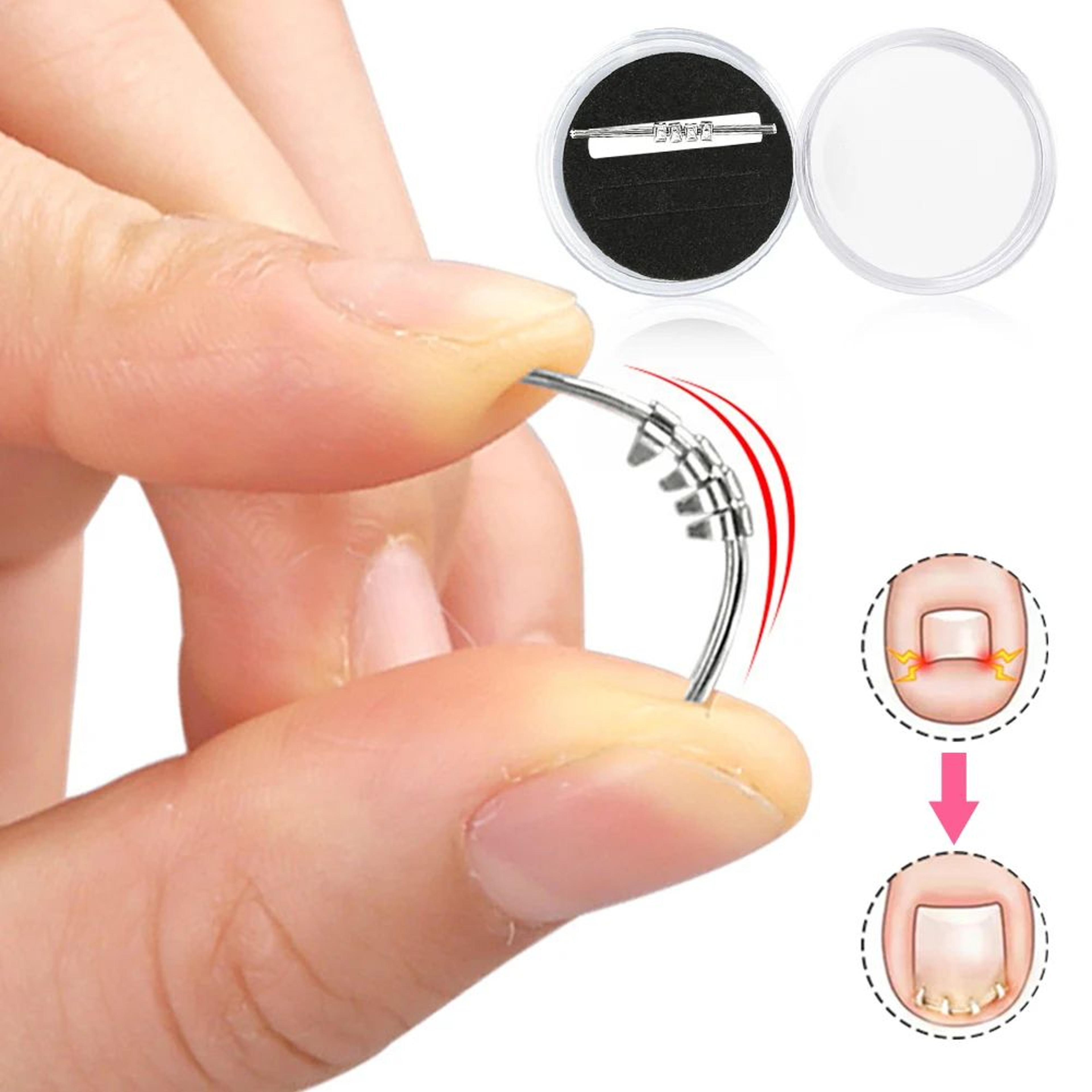 Ingrown Toenail Corrector Clamp Pedicure Tool 1