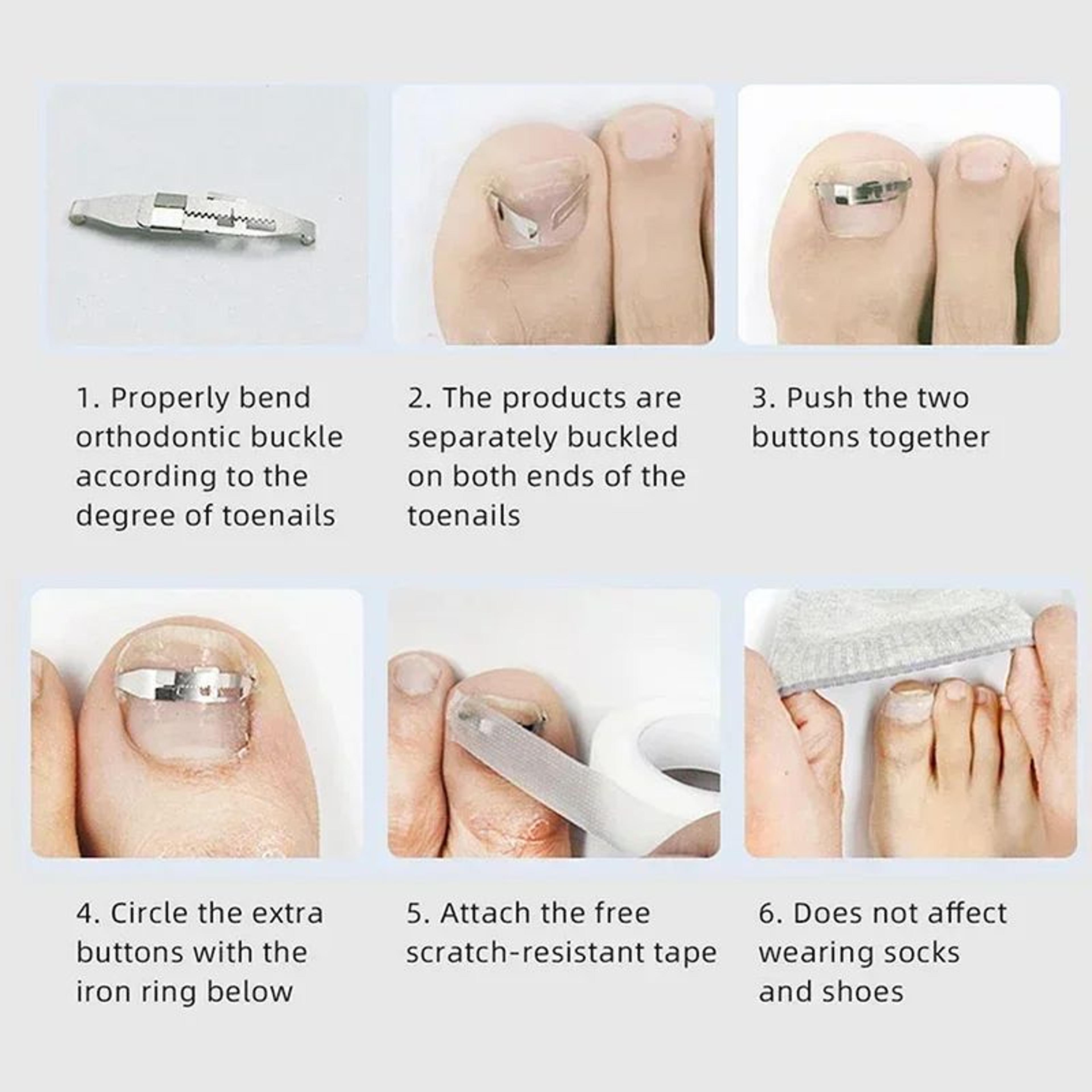 Professional Ingrown Toenail Corrector Tool Set For PainFree Pedicure Care 2