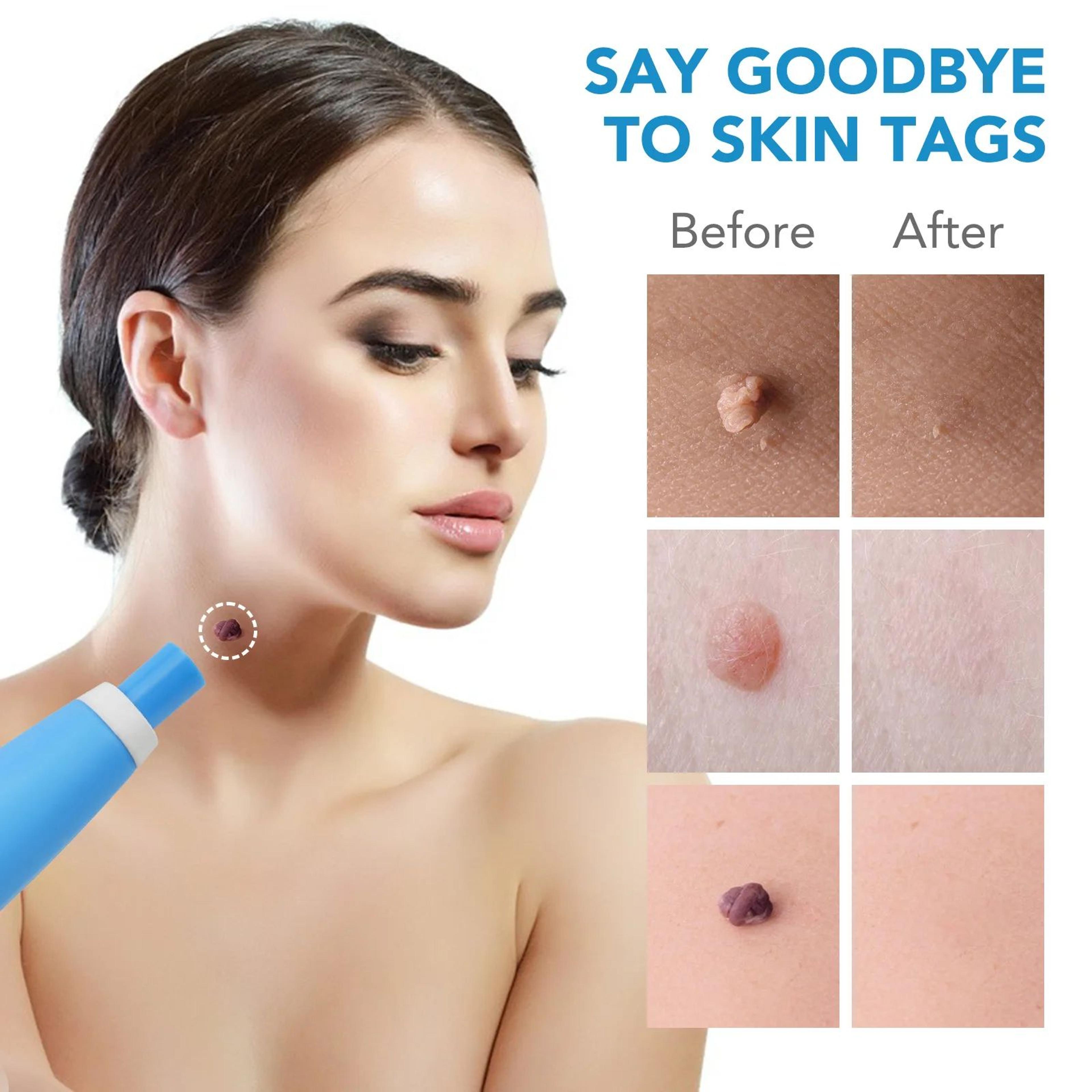 2in1 Micro Skin Tag Remover Kit  AtHome Skin Tag Remover  Precision Band Removal Tool 1