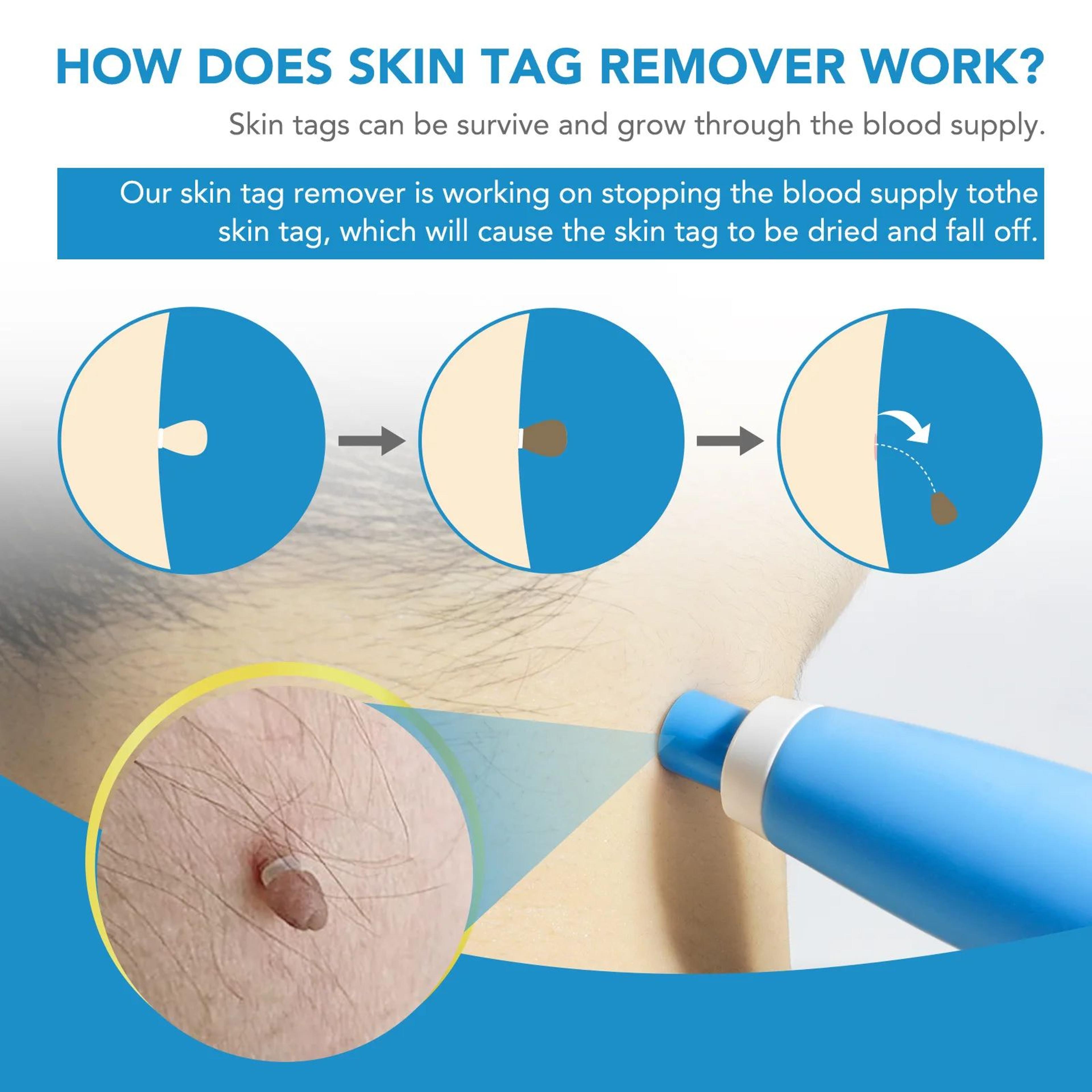 2in1 Micro Skin Tag Remover Kit  AtHome Skin Tag Remover  Precision Band Removal Tool 4