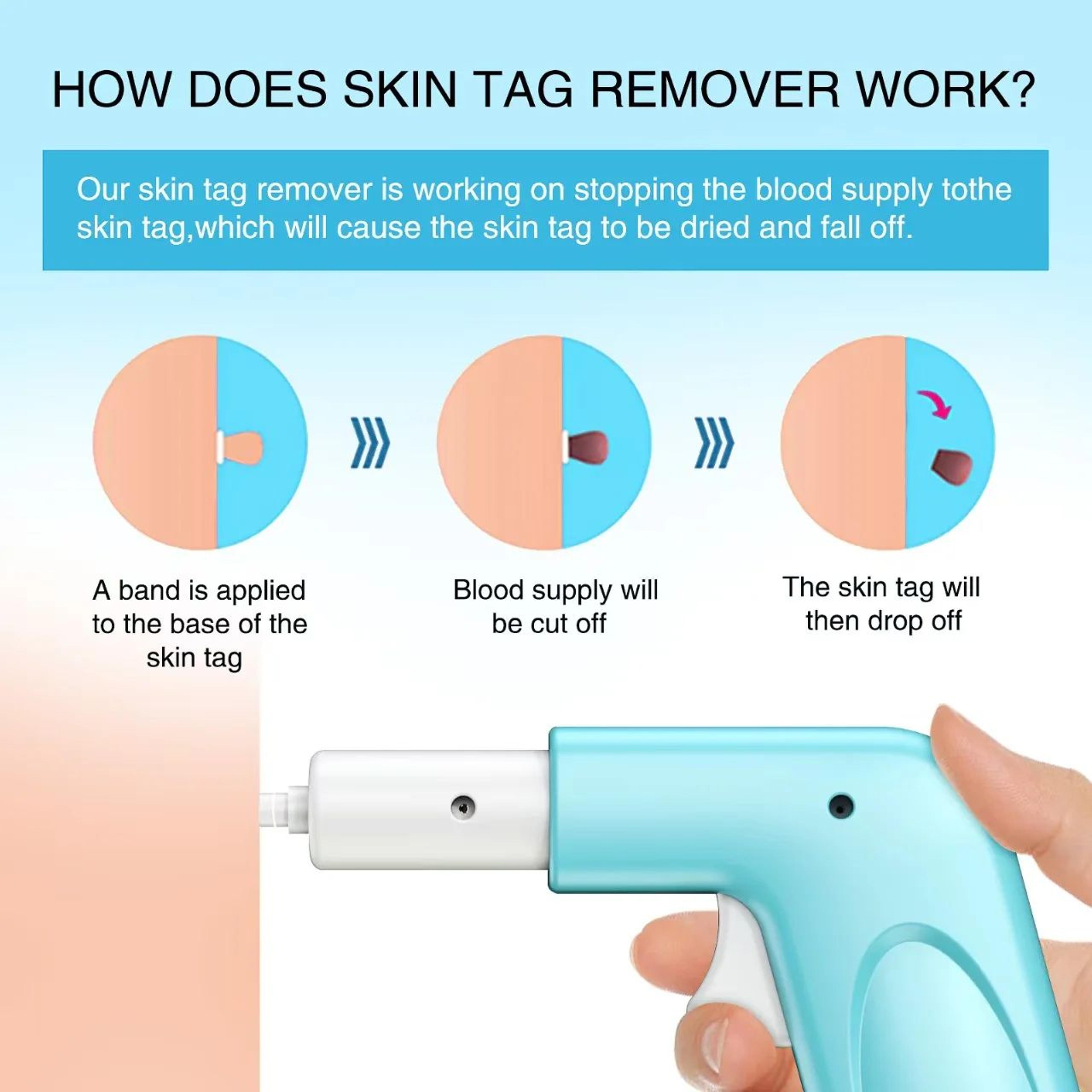 3in1 Painless Skin Tag Removal Kit AtHome Micro Tool For Tags Moles  Warts 2