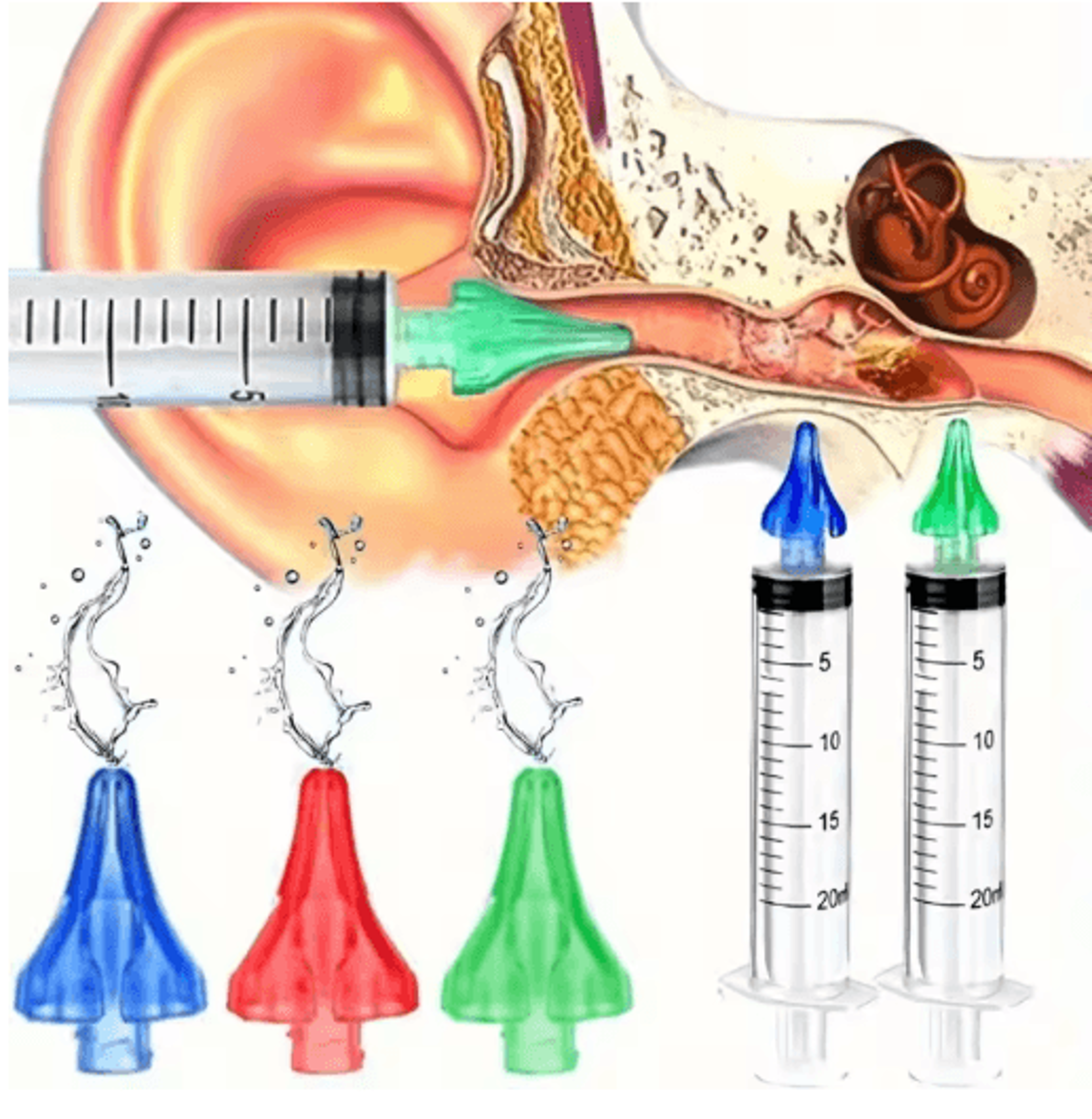 Ear Wax Removal Rinse Syringe Kit Gentle Ear Cleaning Tool With Replacement Tip Nozzle 7