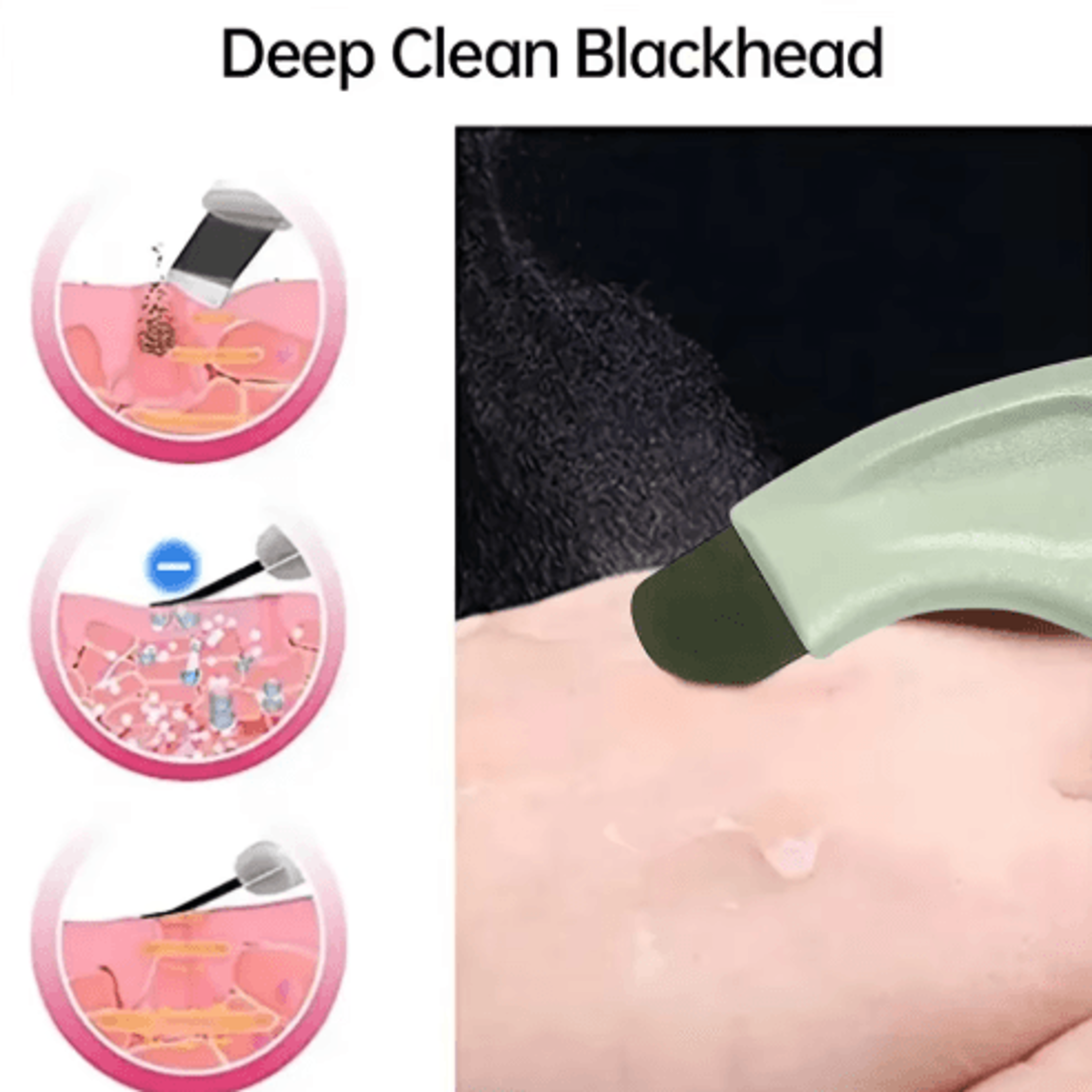 Stainless Steel Blackhead Removal Tool For Deep Pore Cleaning 2