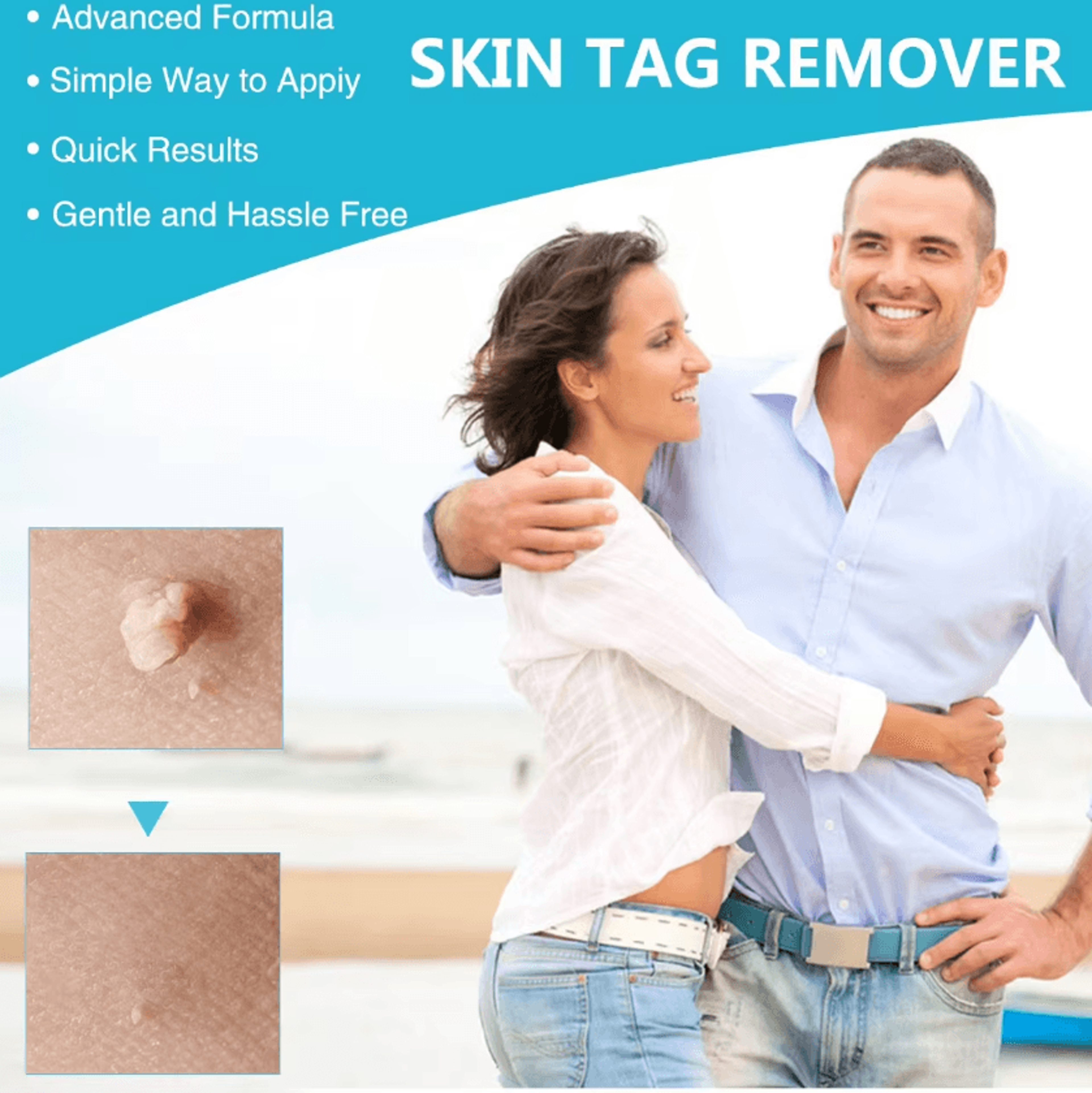3in1 Auto Skin Tag Remover Kit  Painless Mole  Wart Removal Tool 3