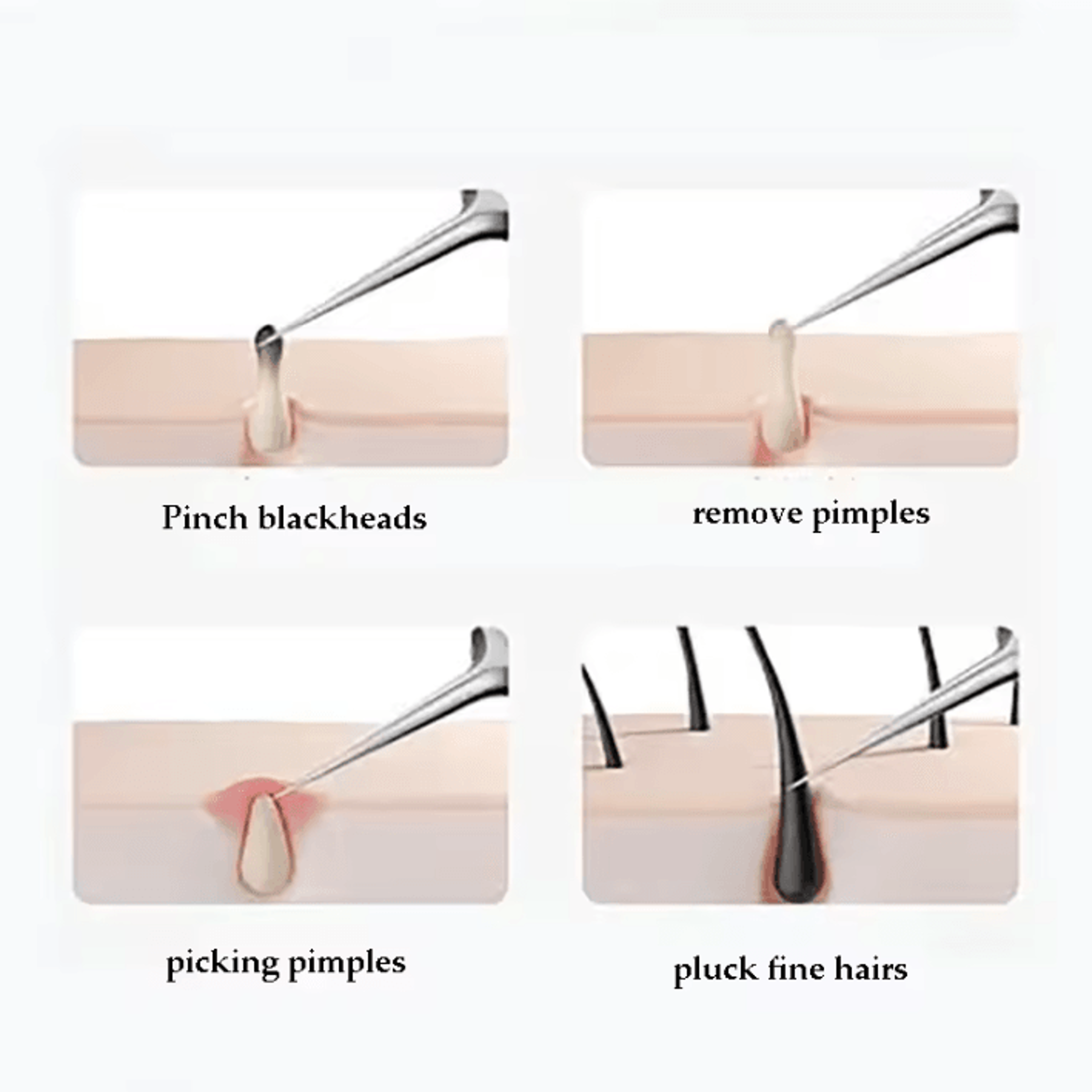 Professional Blackhead Removal Tool Kit Ingrown Hair Tweezers And Acne Extractor Set 2