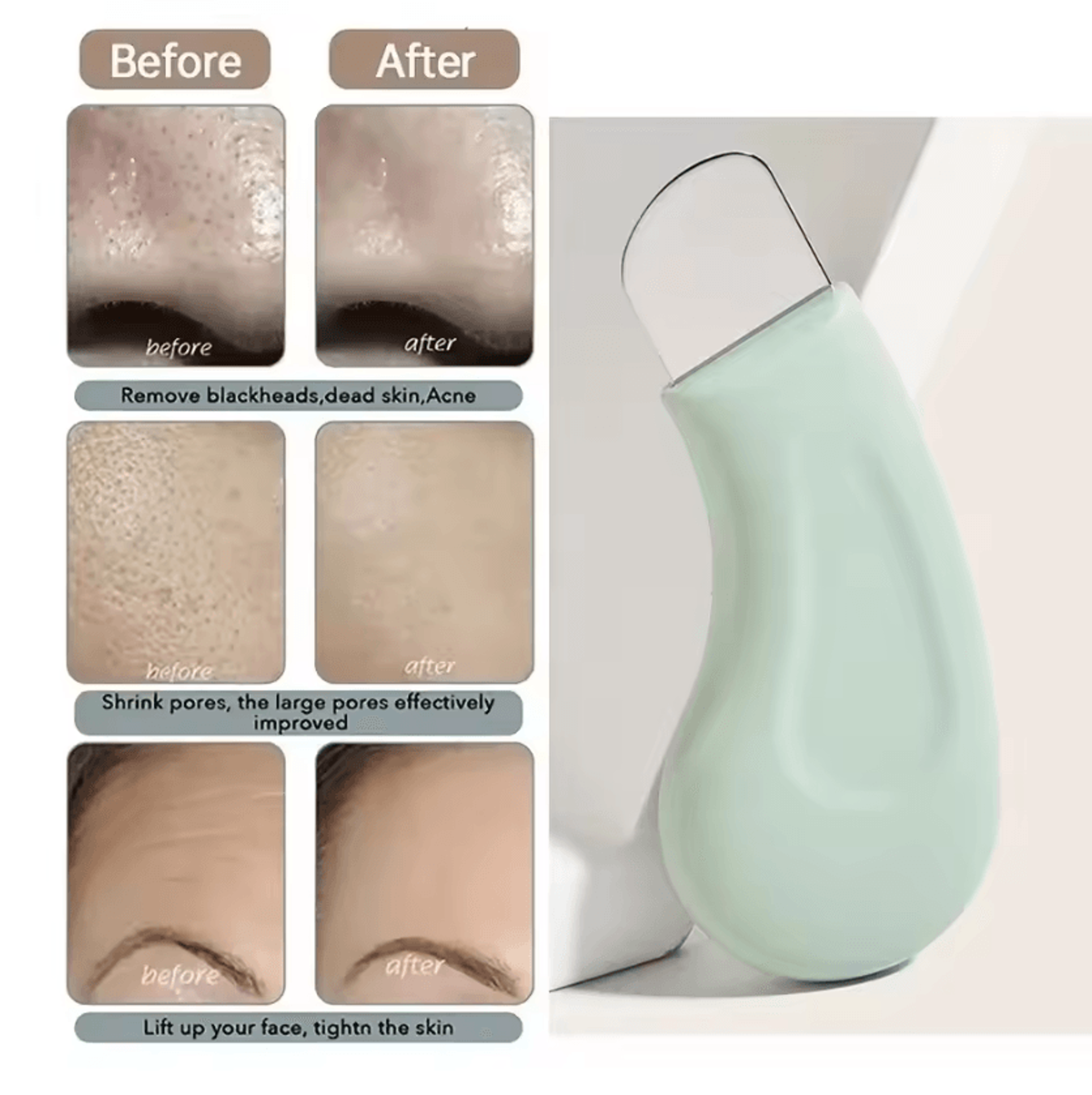 Deep Cleansing Blackhead And Whitehead Remover Tool For Face And Nose 0