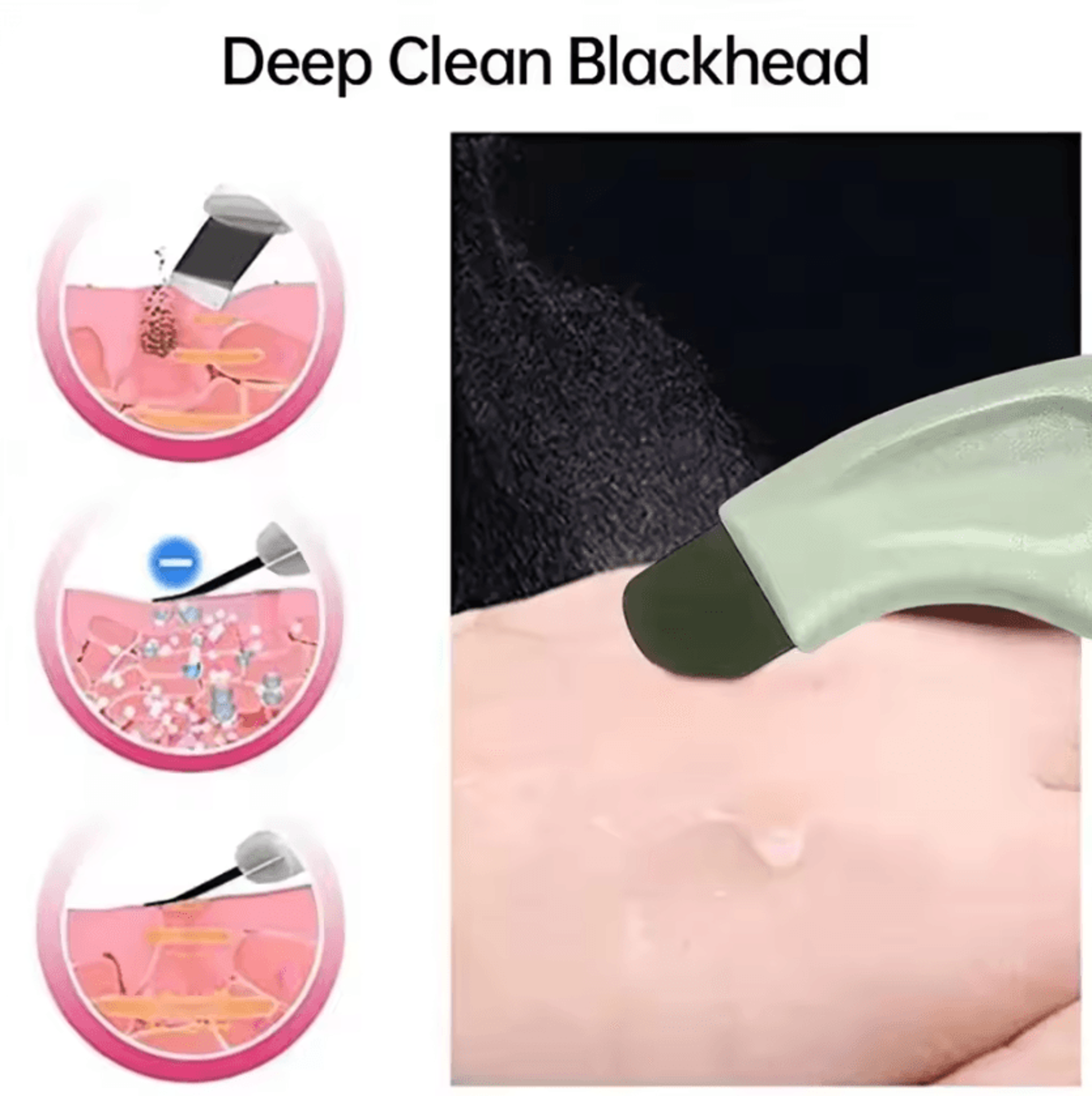 Deep Cleansing Blackhead And Whitehead Remover Tool For Face And Nose 1