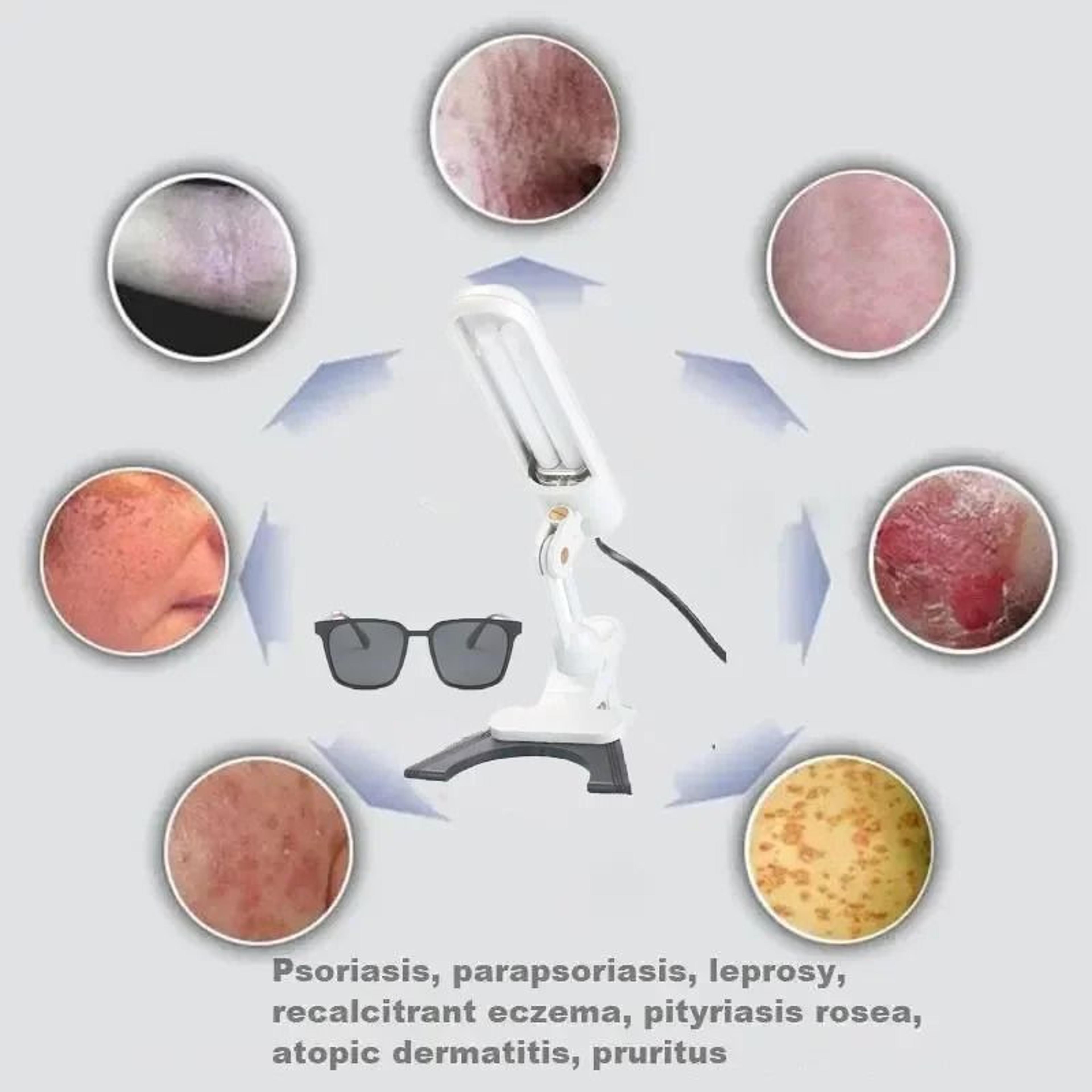 Handheld Psoriasis UVB Phototherapy Device And Narrowband UV Vitiligo Instrument 2