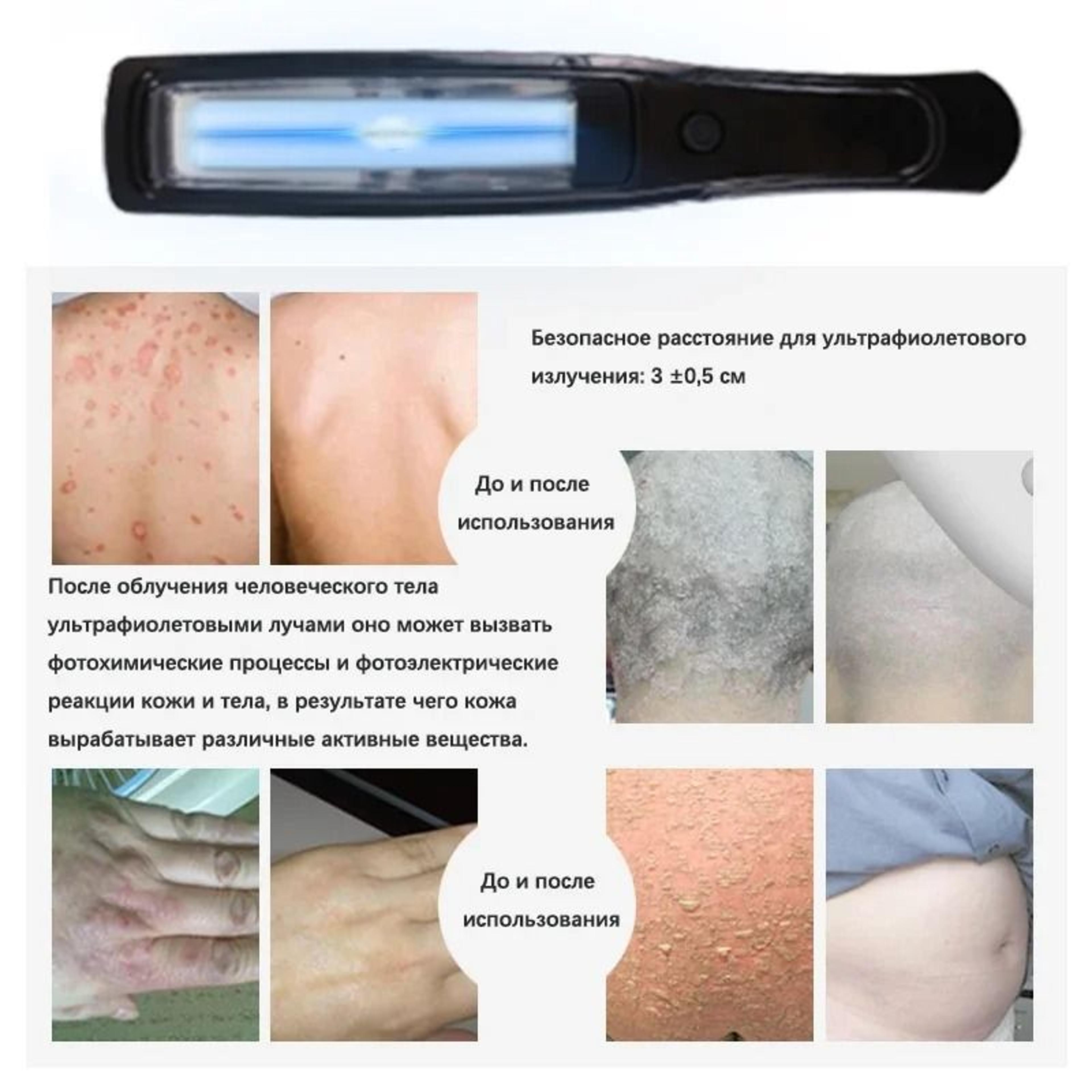 311nm Narrowband UVB Phototherapy Lamp For Skin Treatment 1