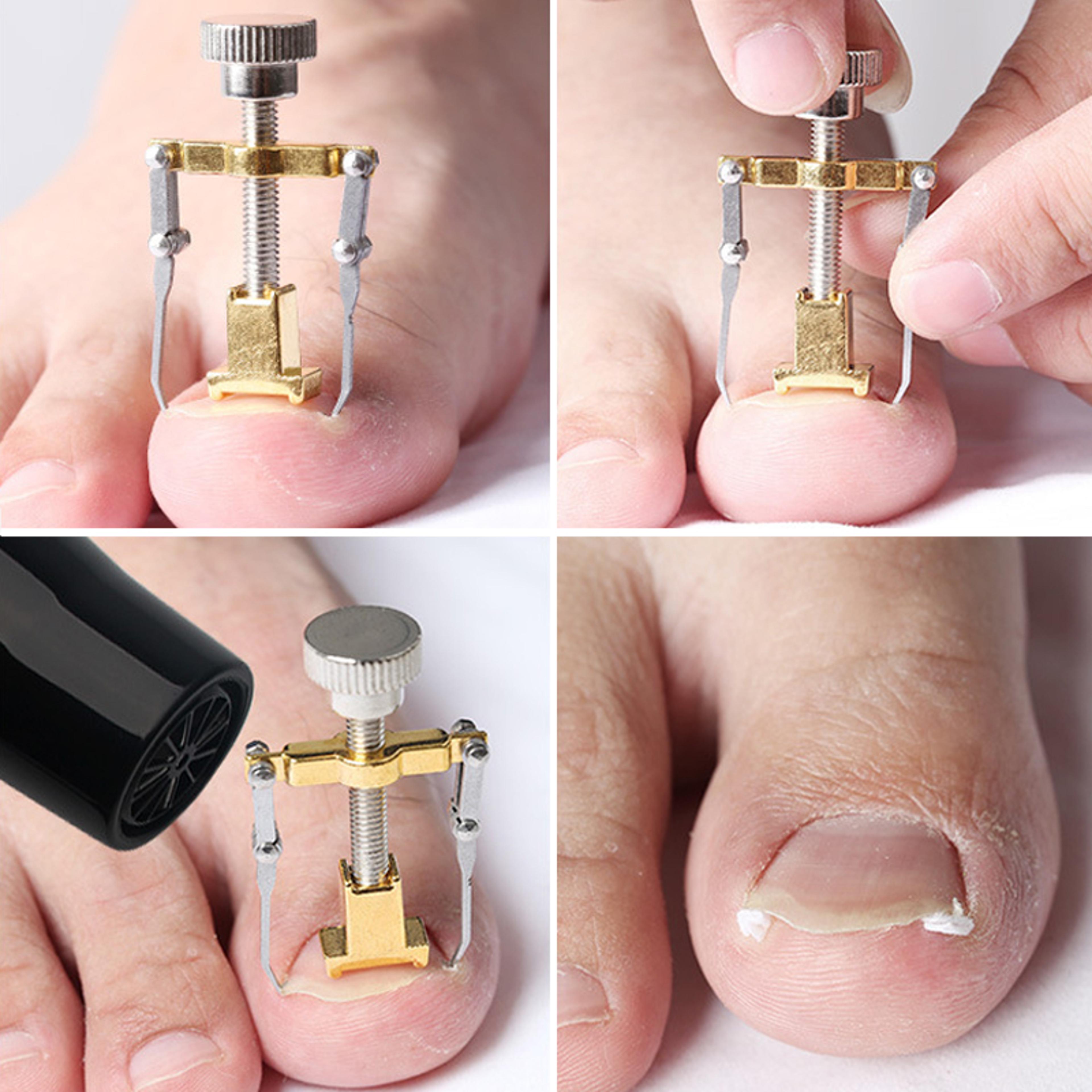 Stainless Steel Ingrown Toenail Lifter Foot Care Tool Paronychia Corrector Nail Straightener Clip 2