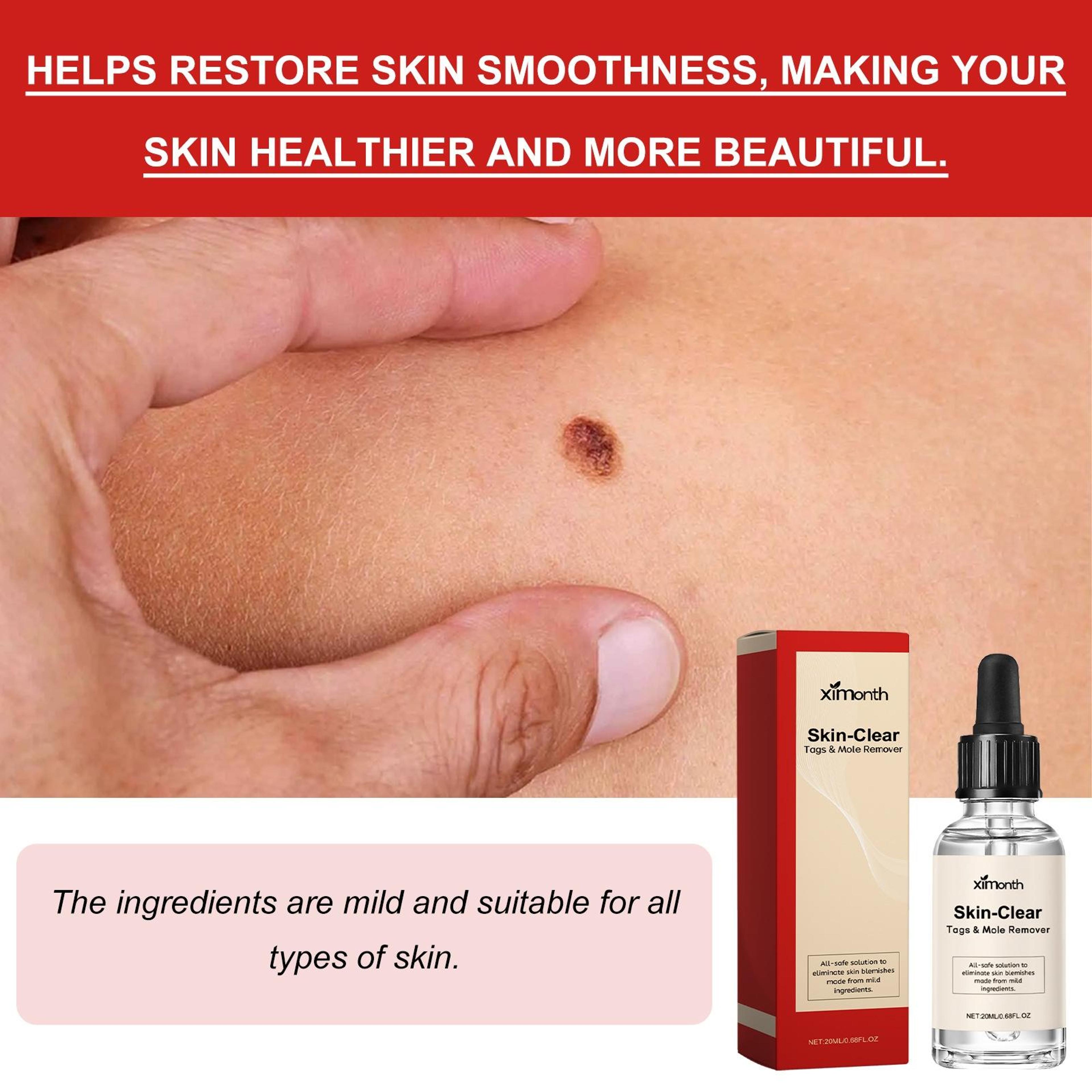 Ximonth Natural Wart Remover Liquid For Moles Skin Tags  Dark Spots 20ml 4