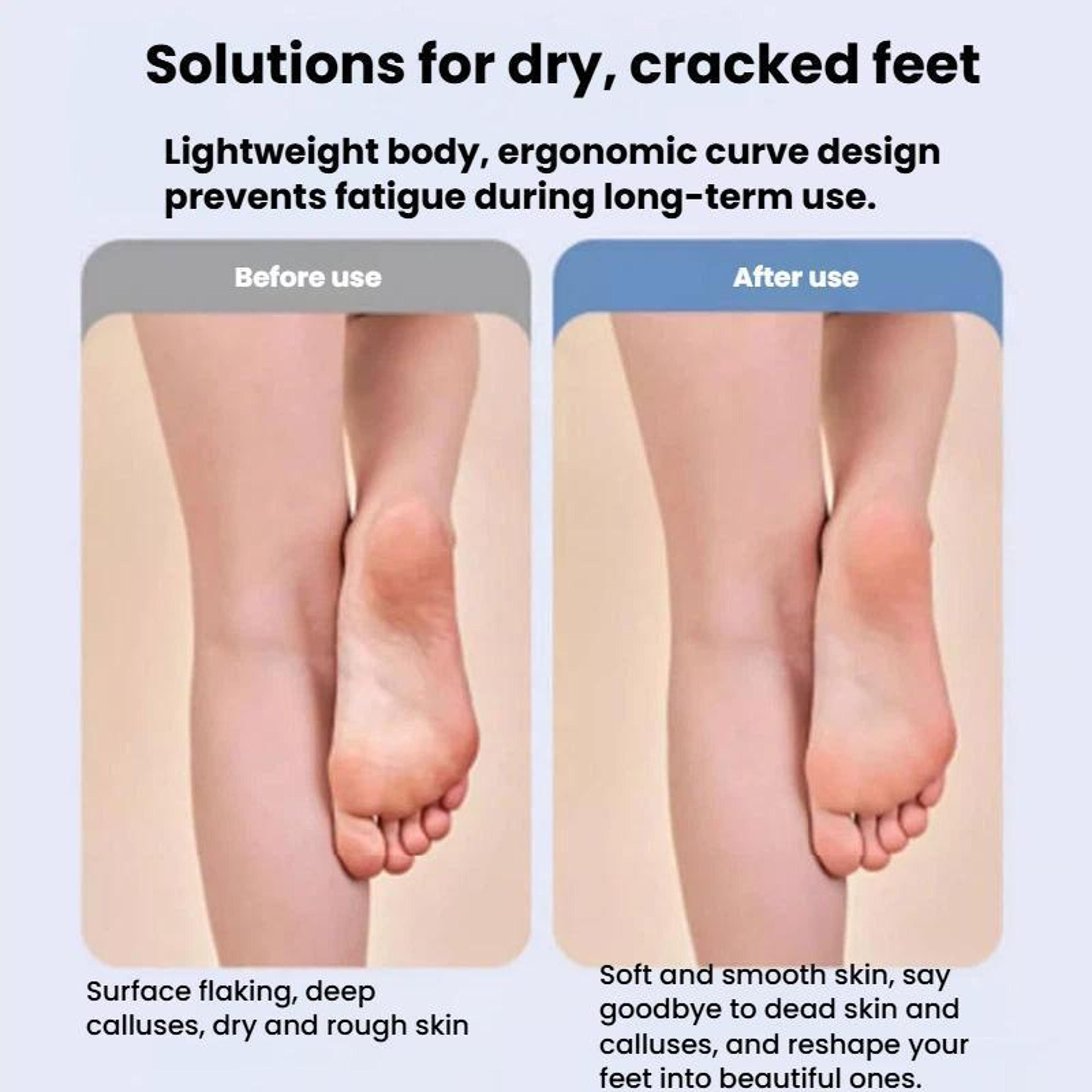Smart Vacuum Electric Foot File With LCD Display  Waterproof Callus Remover 7