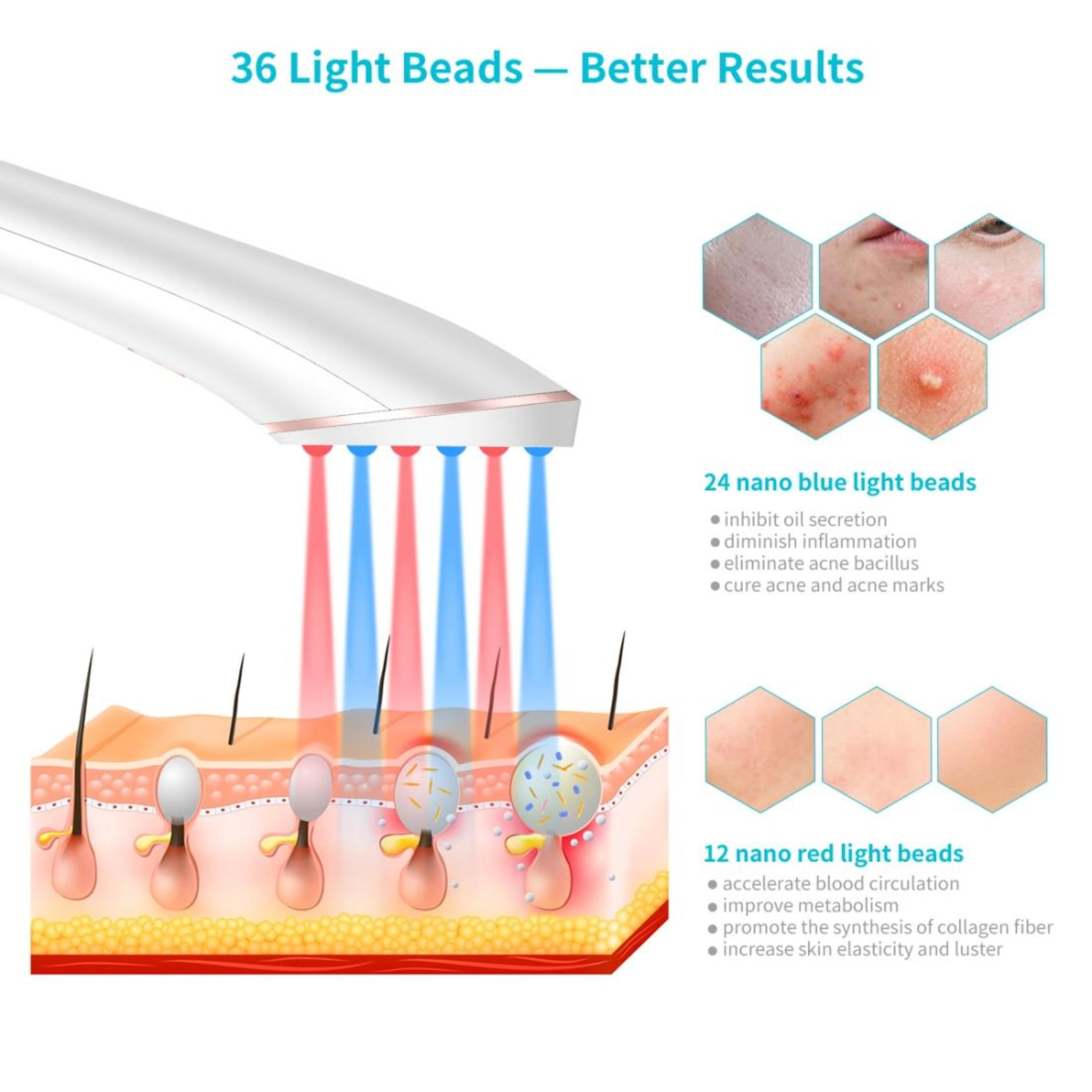 LED Acne Treatment Device With Blue  Red Light Therapy Rechargeable Wand 1