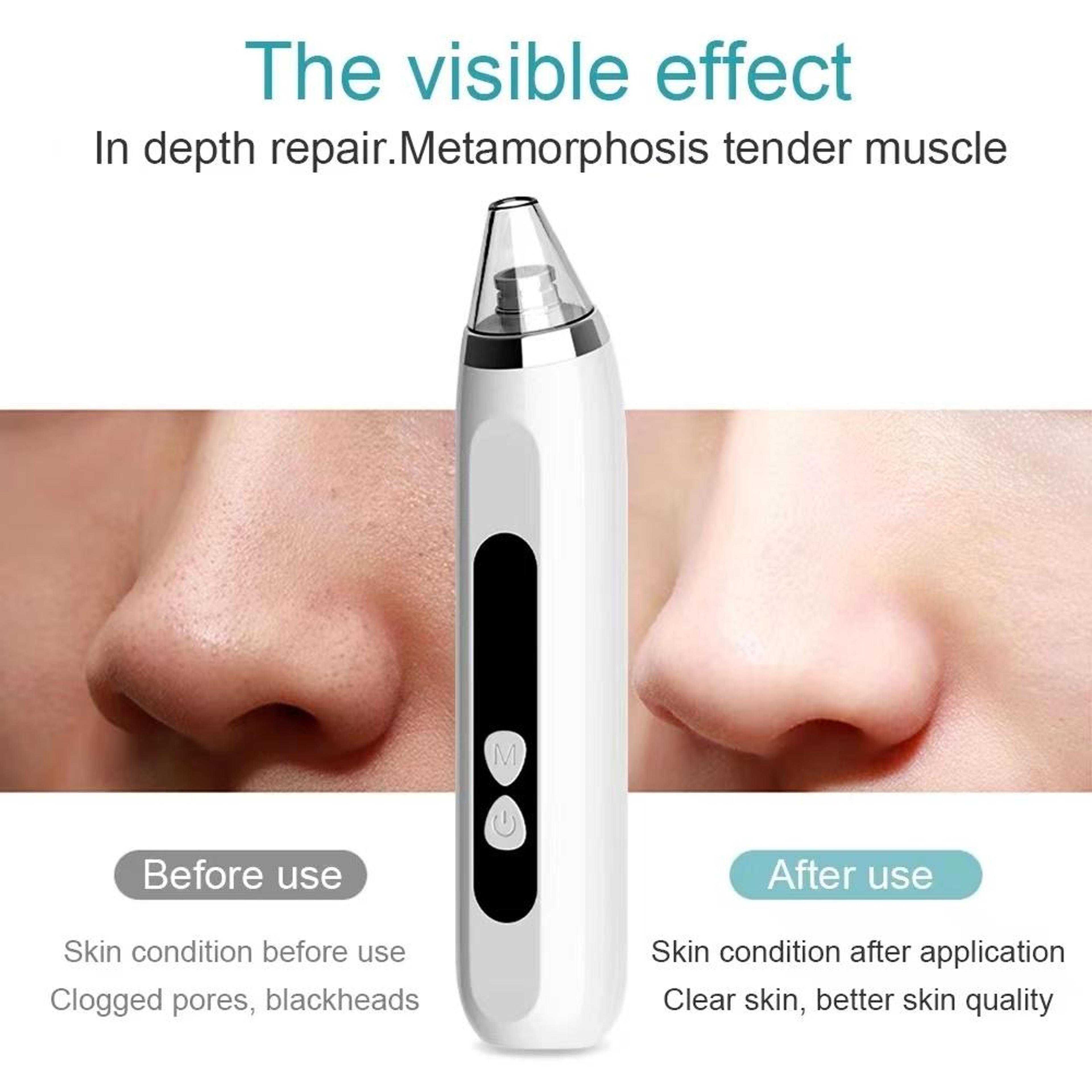 Blackhead Remover Vacuum Deep Pore Cleaner With 3 Suction Levels And 3 Facial Cleaning Heads 4