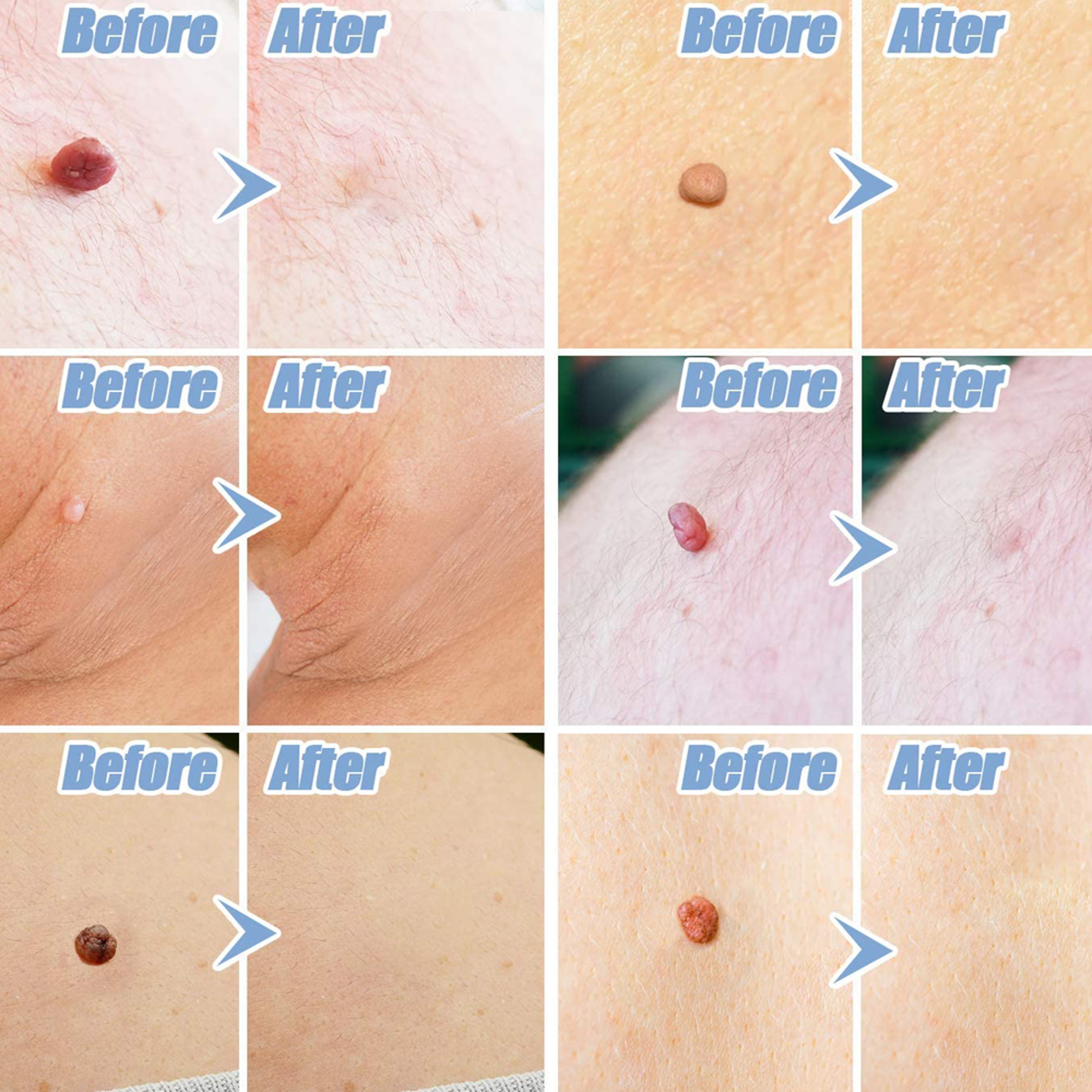 Skin Tag Remover