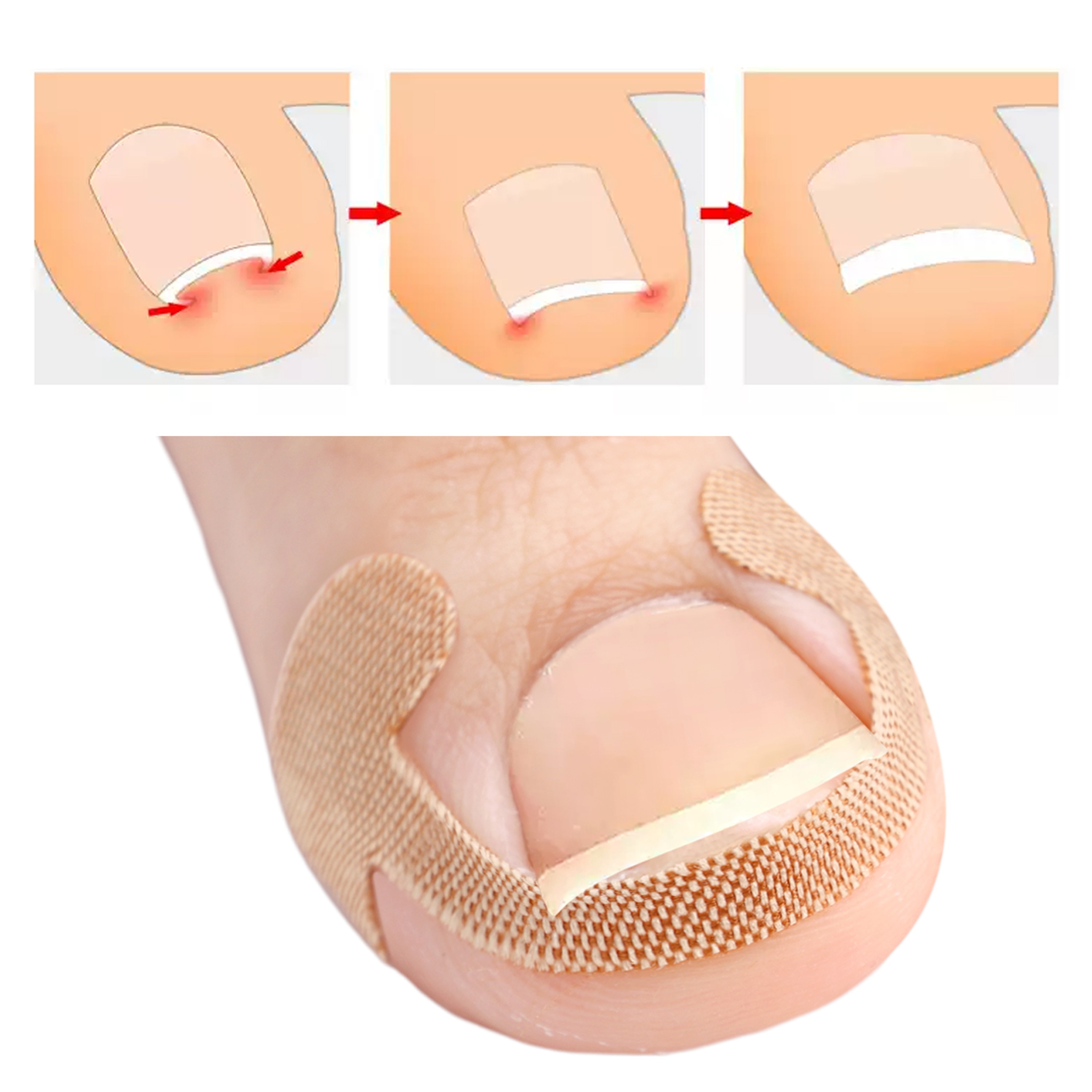 Lasting Adhesion Waterproof Nail Correction Strips, Professional Toe Care Pedicure Tools, Stickers Elasticity – view 3