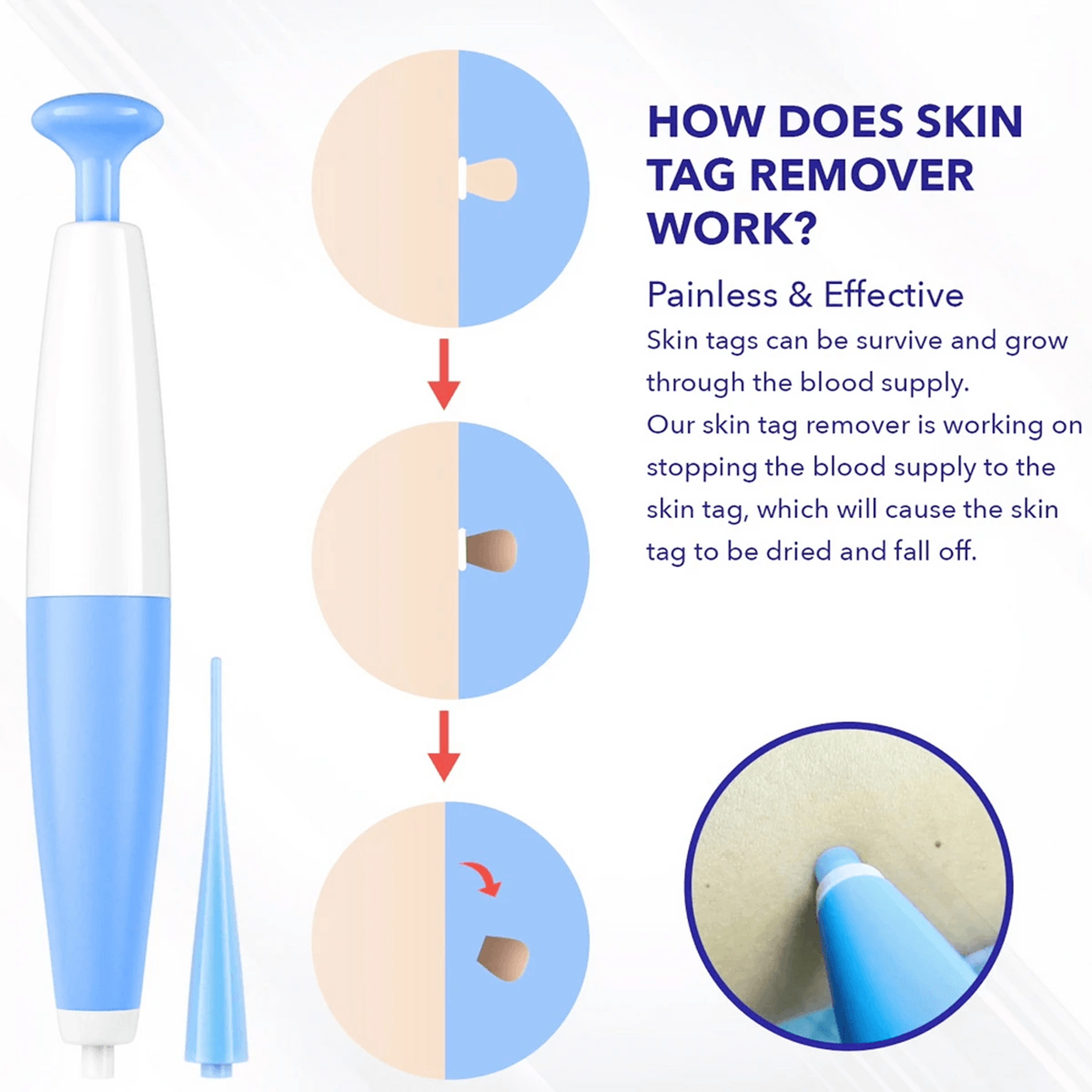 Painless Skin Tag Removal Kit For Small To Medium Size Skin Tags 2