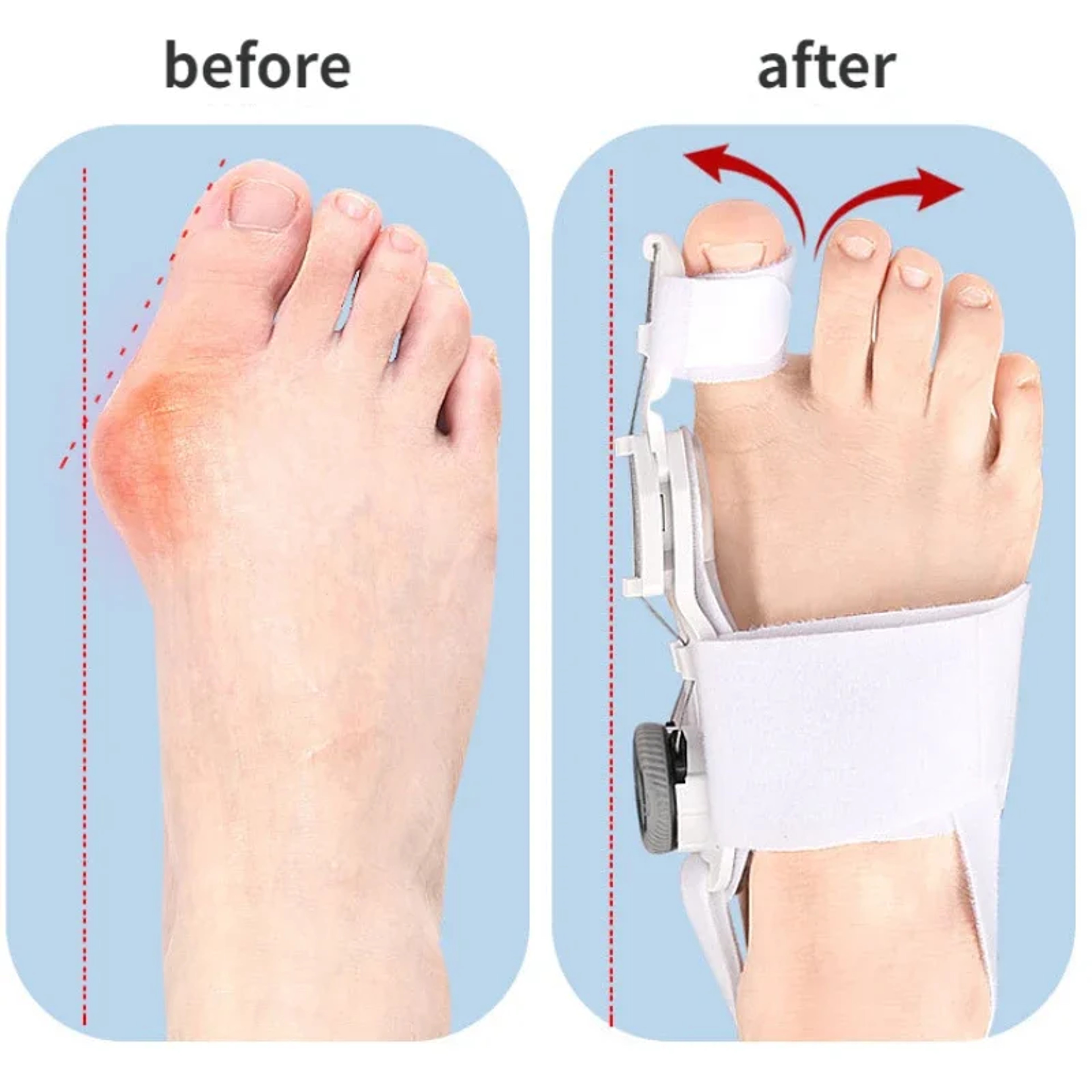 Adjustable Bunion Corrector  Toe Separator  Unisex Hallux Valgus Braces For Foot Pain Relief 2