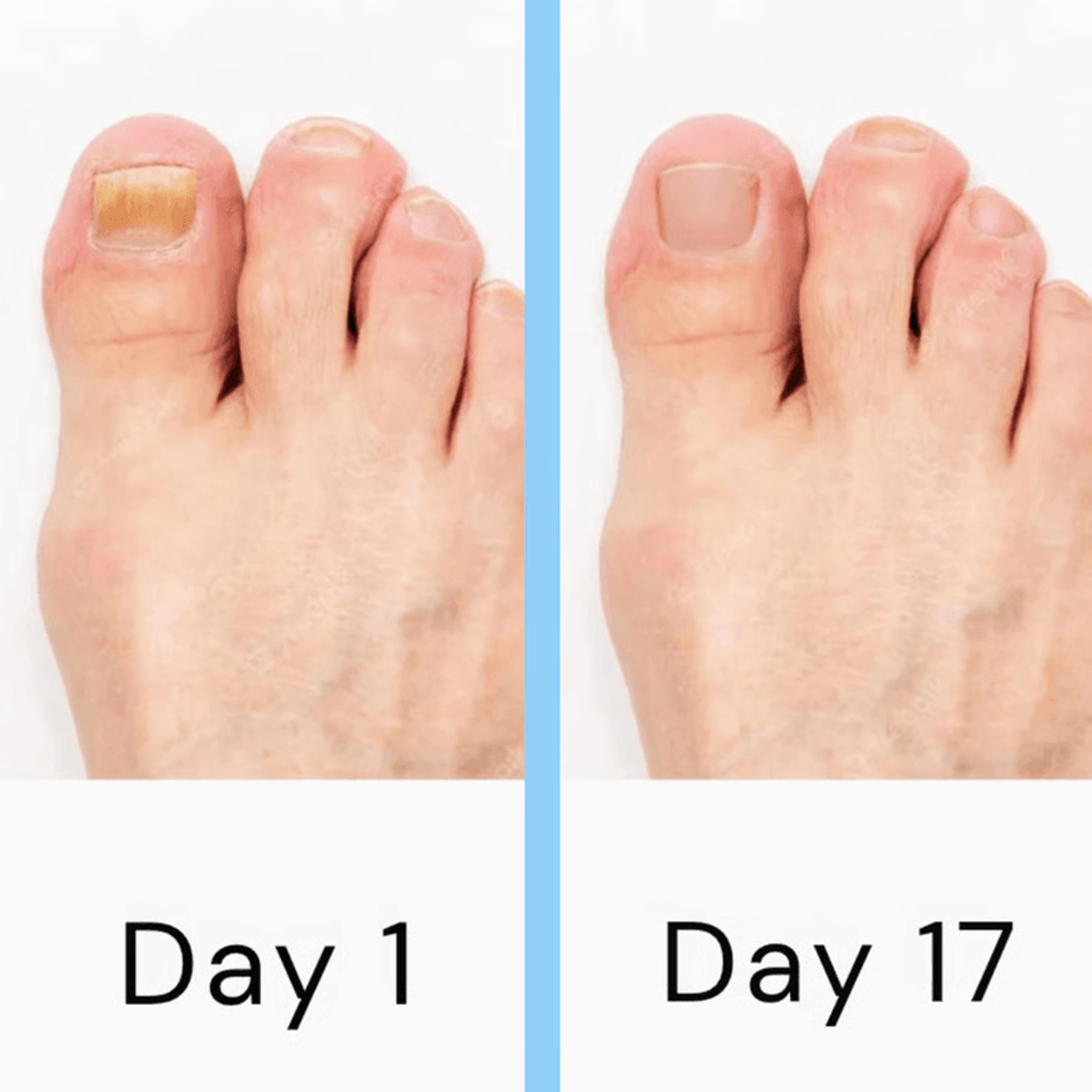 Effective toenail fungus treatment with laser