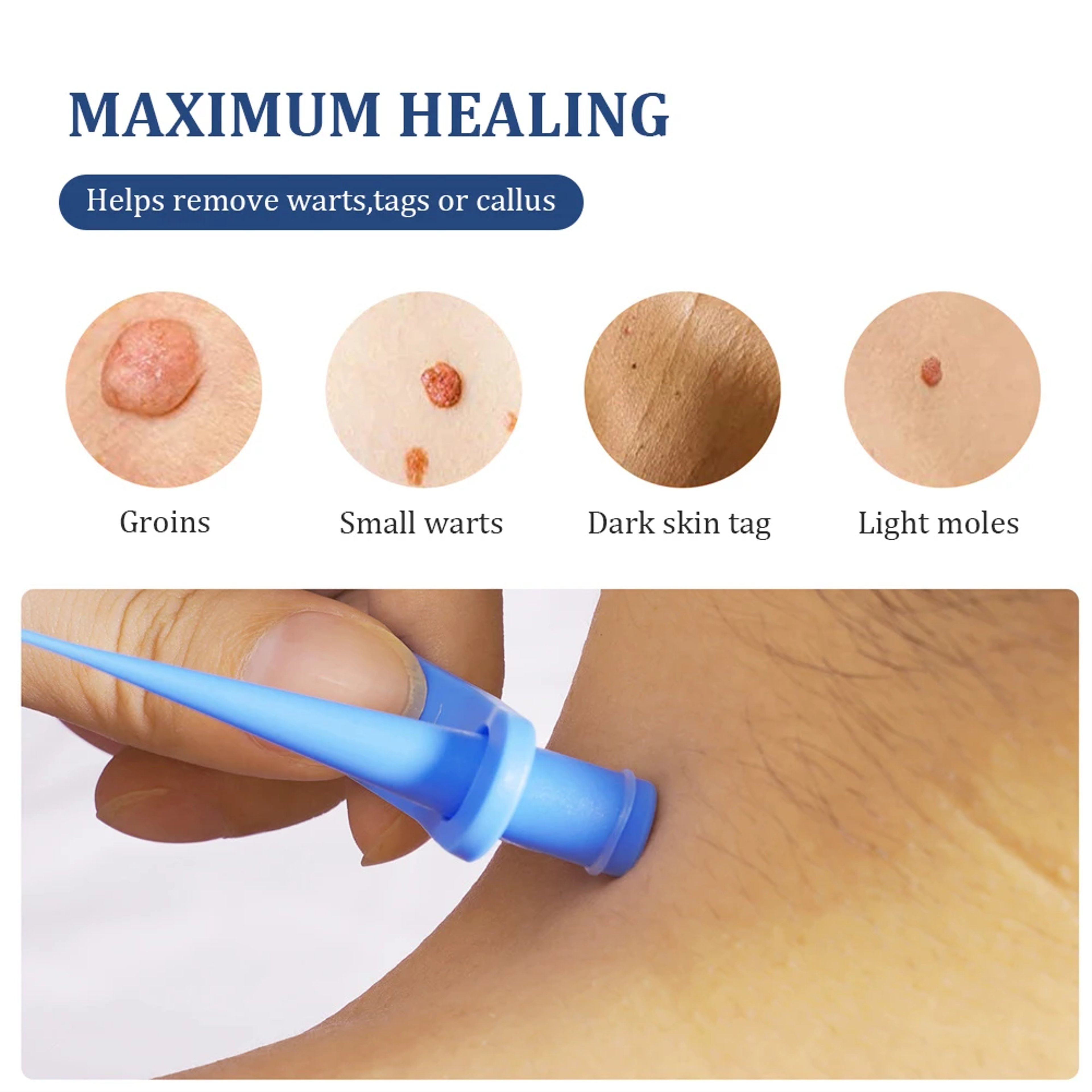 DermPrecision Skin Tag & Wart Removal Kit Portable Micro Treatment Tool – view 6