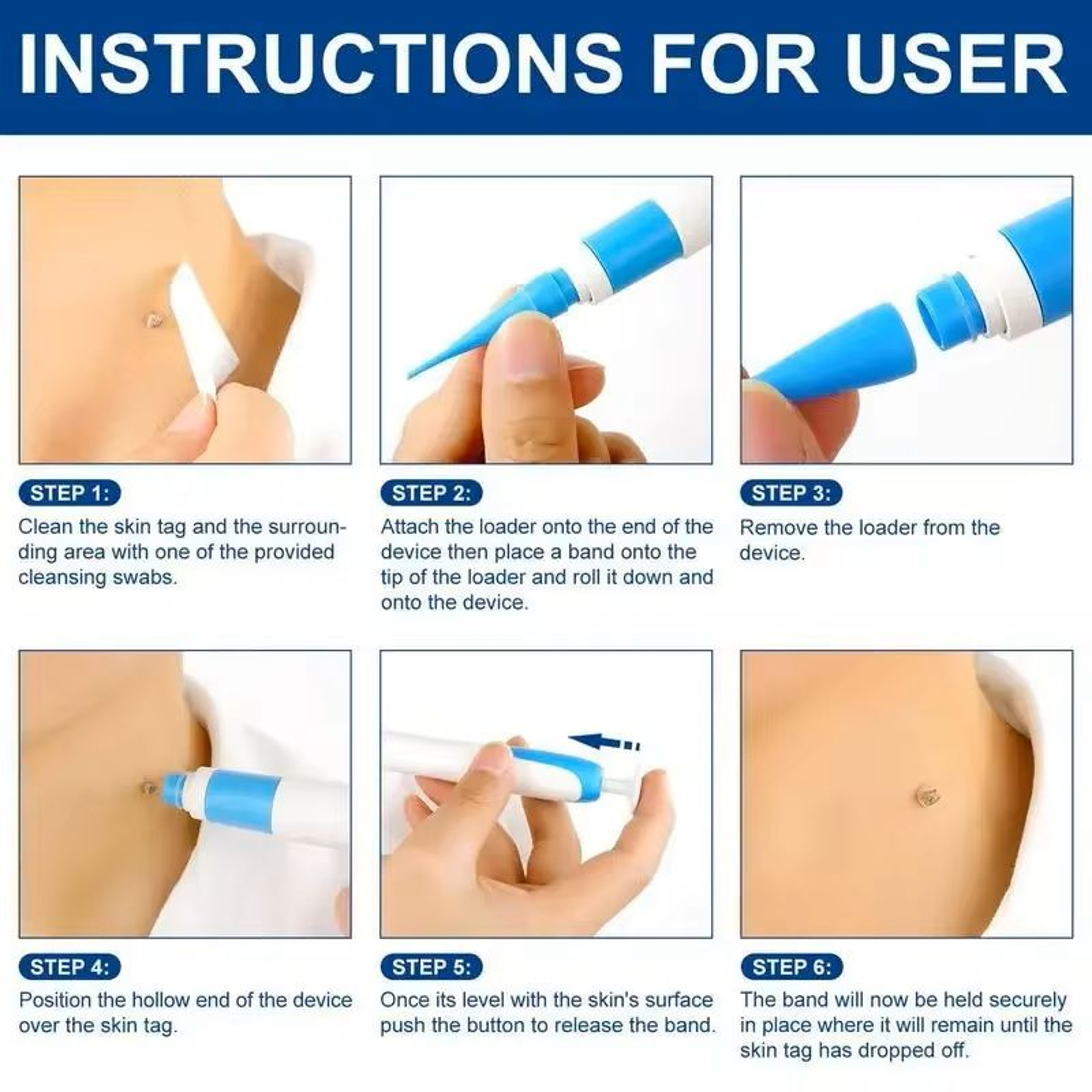 Skin Tag Removal Pen Kit For Painless Tag Removal 4mm To 9mm 2