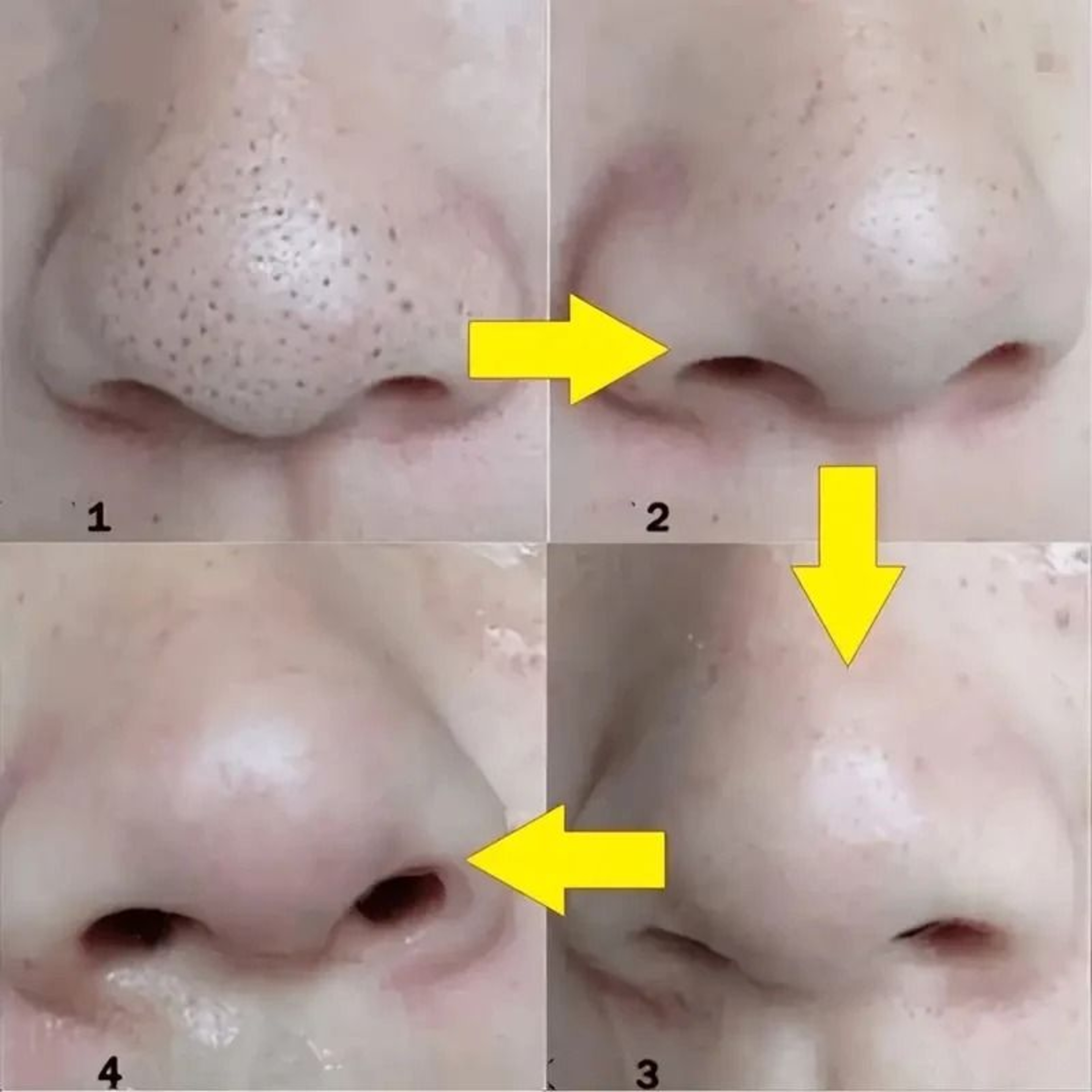 Nose Blackhead Remover Mask 2