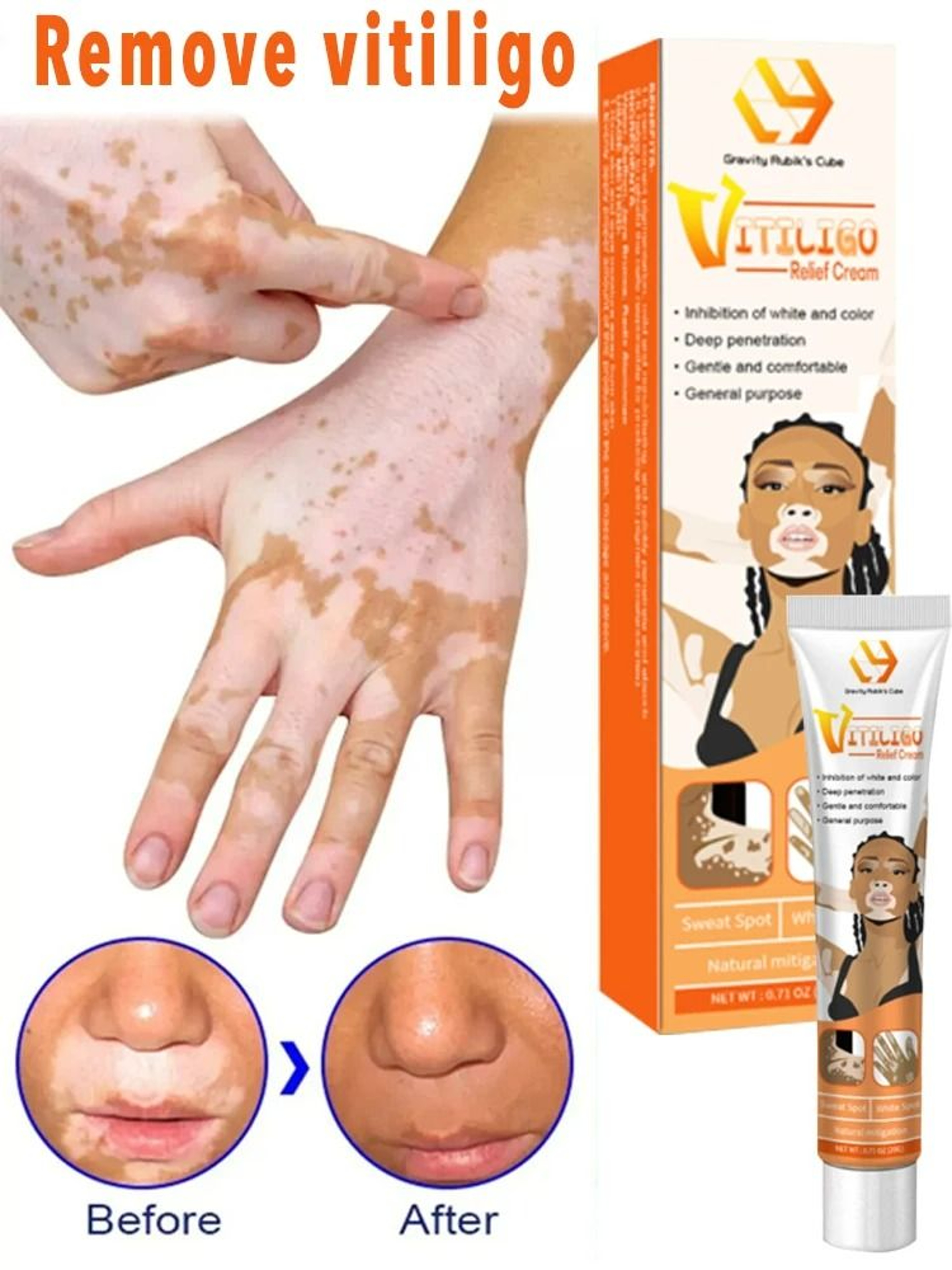 Targeted Vitiligo  White Spot Care Ointment 1