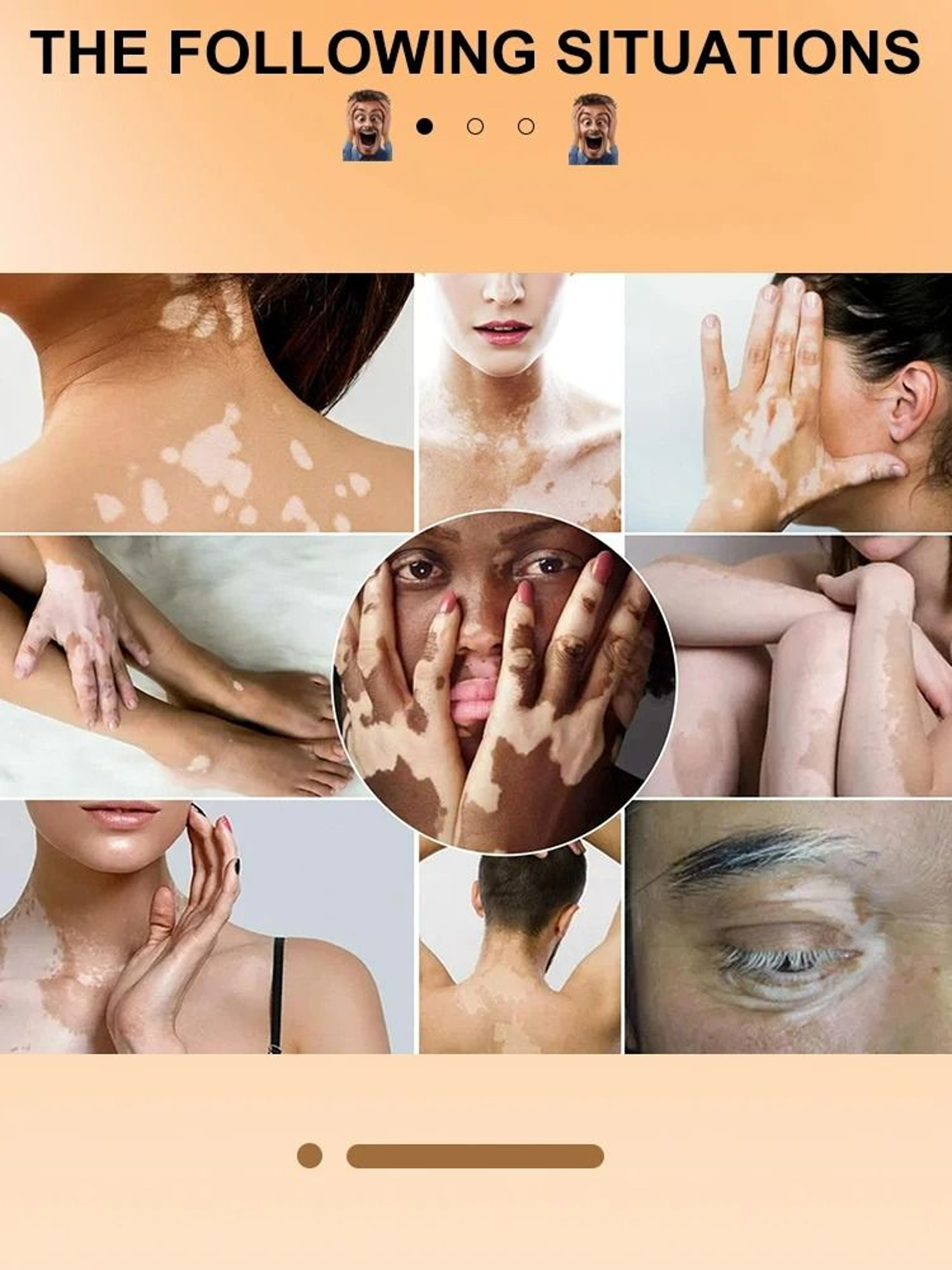 Targeted Vitiligo  White Spot Care Ointment 2