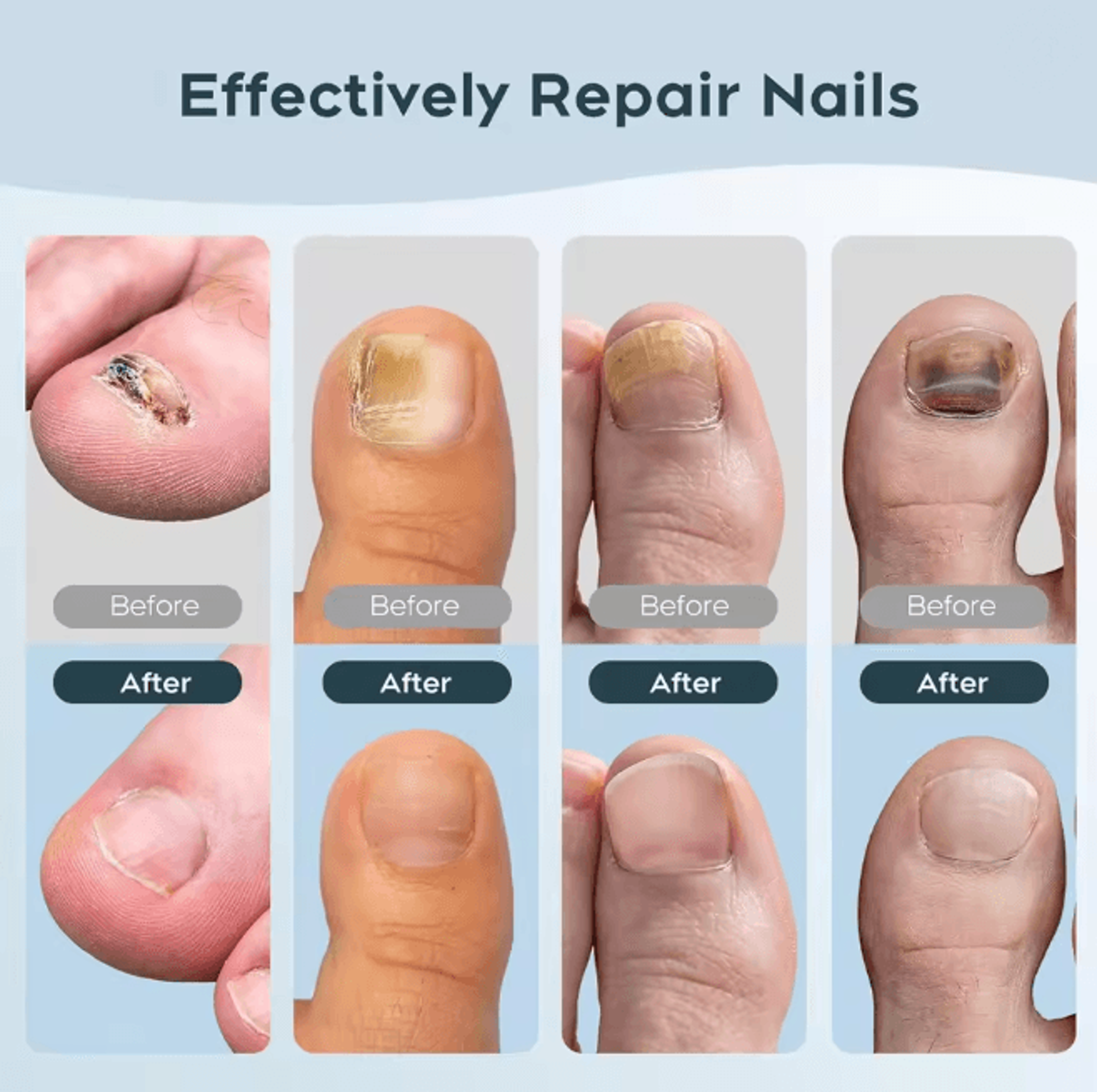 ClearNail Laser Nail Fungus Treatment Device For Toenail Care 3