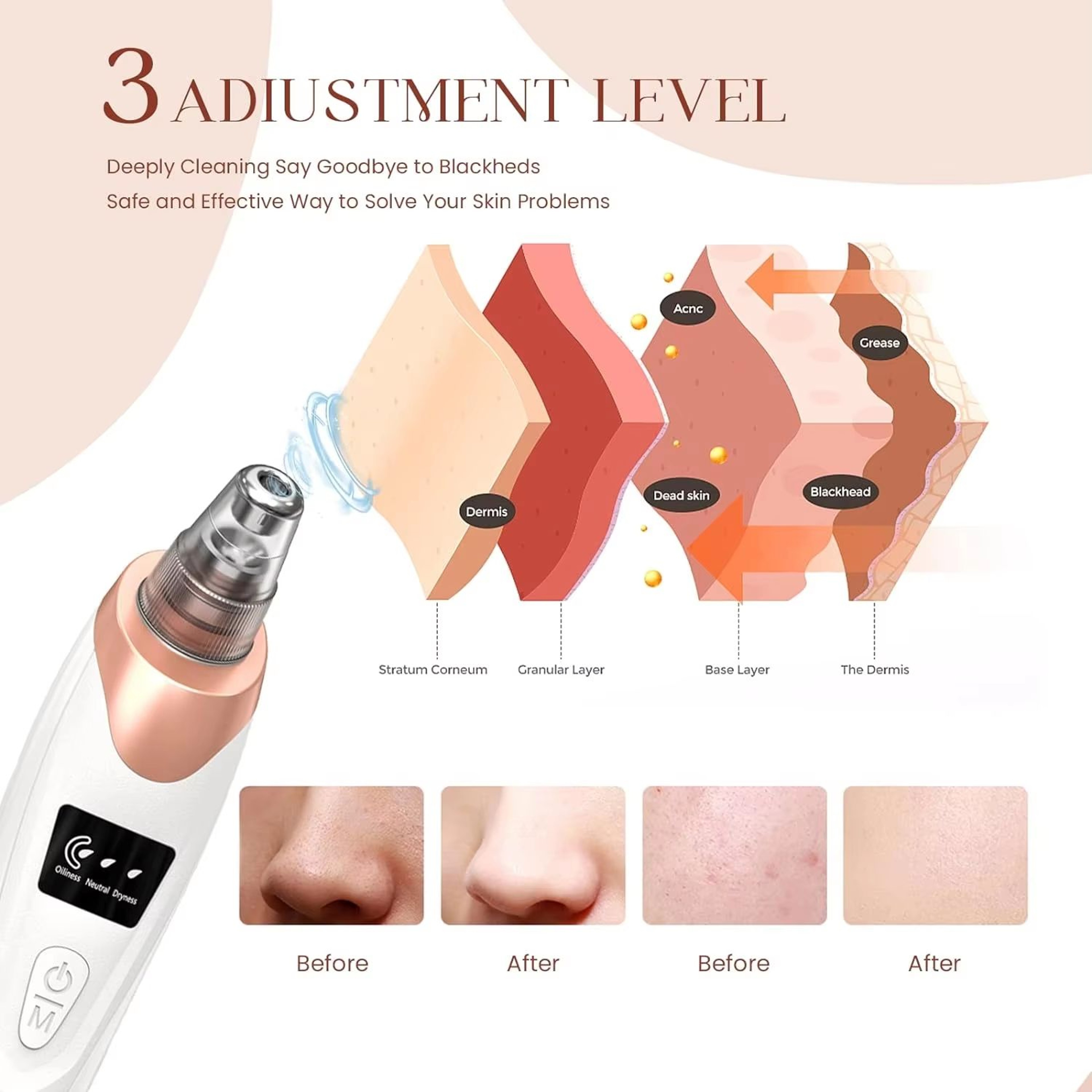 Electric Blackhead Remover Vacuum Pore Cleaner For Acne And Deep Facial Extraction 2