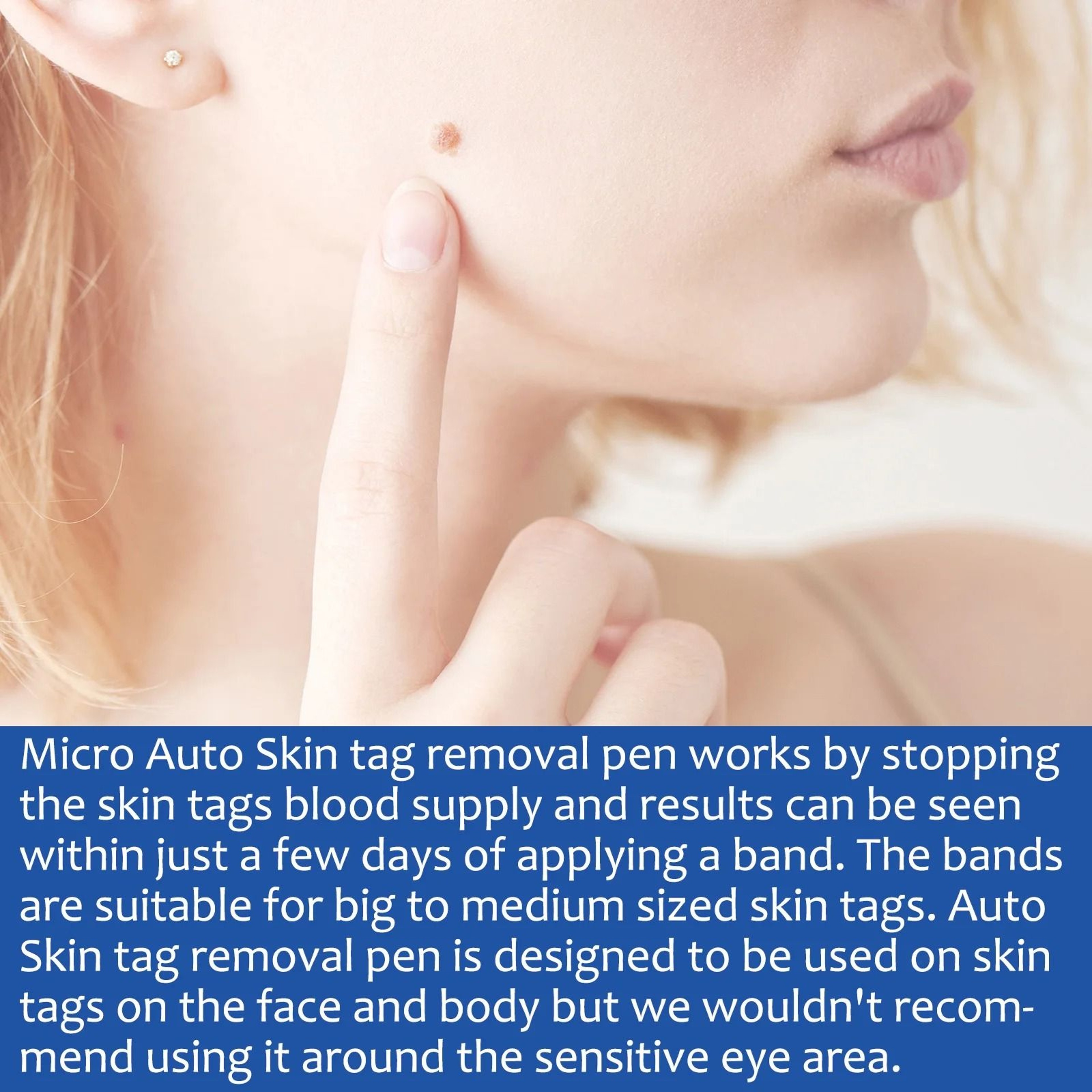 2 In 1 Painless Auto Skin Tag And Mole Remover Kit 3